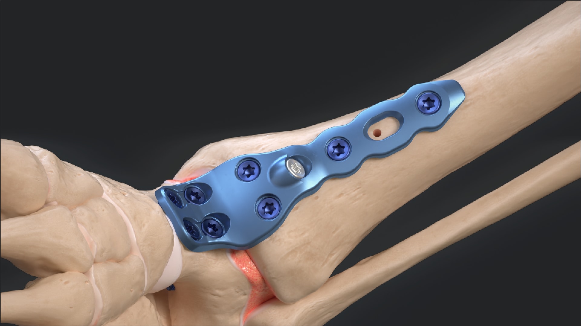 Arthrex Ankle Fusion Plating System