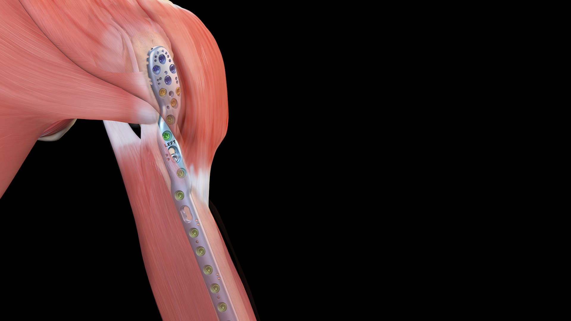 Arthrex ALPHA Proximal Humeral Plate System Operative Technique