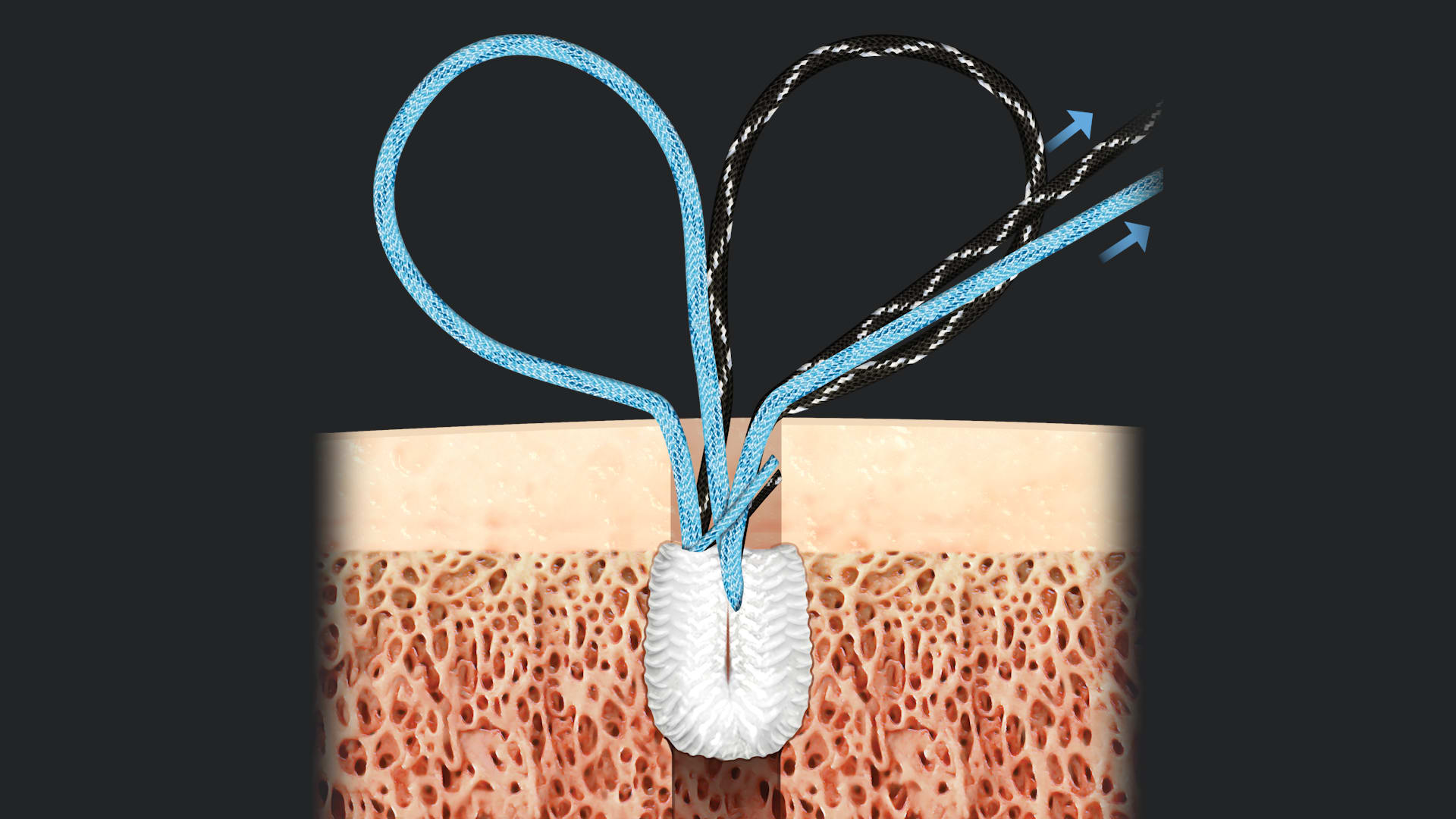 Arthrex Medial Collateral Ligament Reconstruction Using Double Loaded