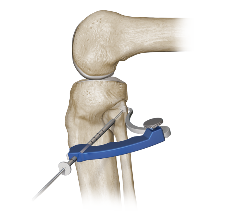lateral collateral ligament