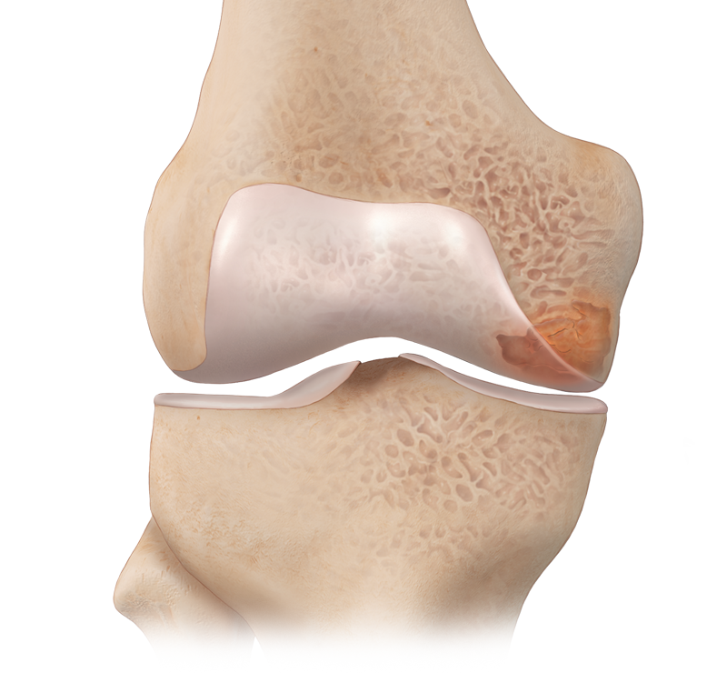 Arthrex - Posterior Iliac Crest Bone Marrow Aspiration - Prone