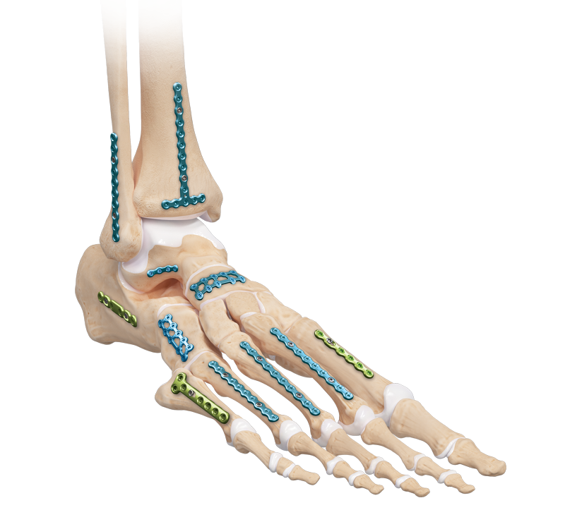 Callus Removal – Da Vinci Foot & Ankle
