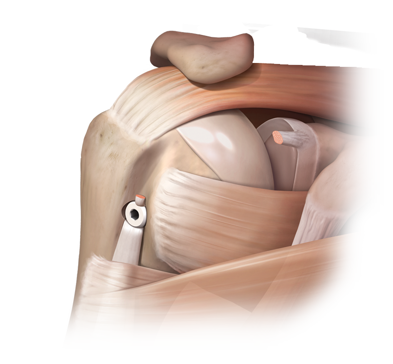 bicep tenodesis bpc 157 Arthrex Adult