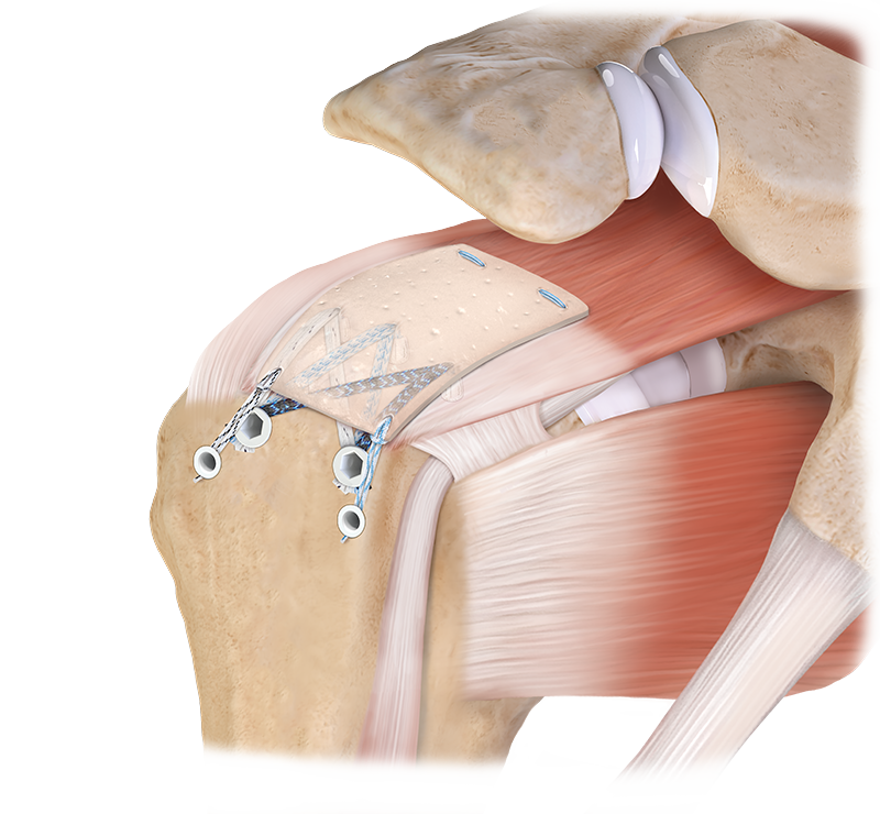 Rotator Cuff Repair Breakthrough with CuffMend!: Advantage Orthopedics:  Orthopedic Shoulder Surgeons