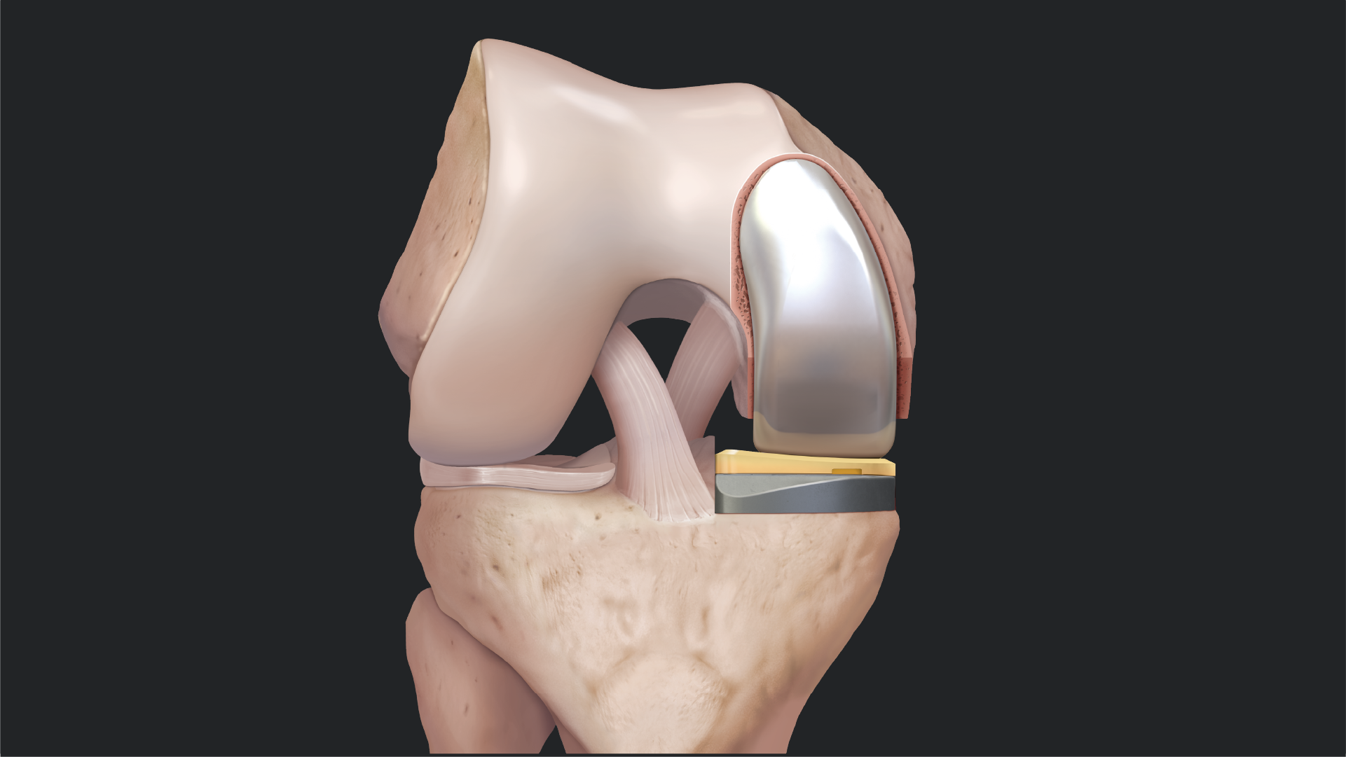 Arthrex - iBalance® UKA Disposable Tibial Cutting Guide