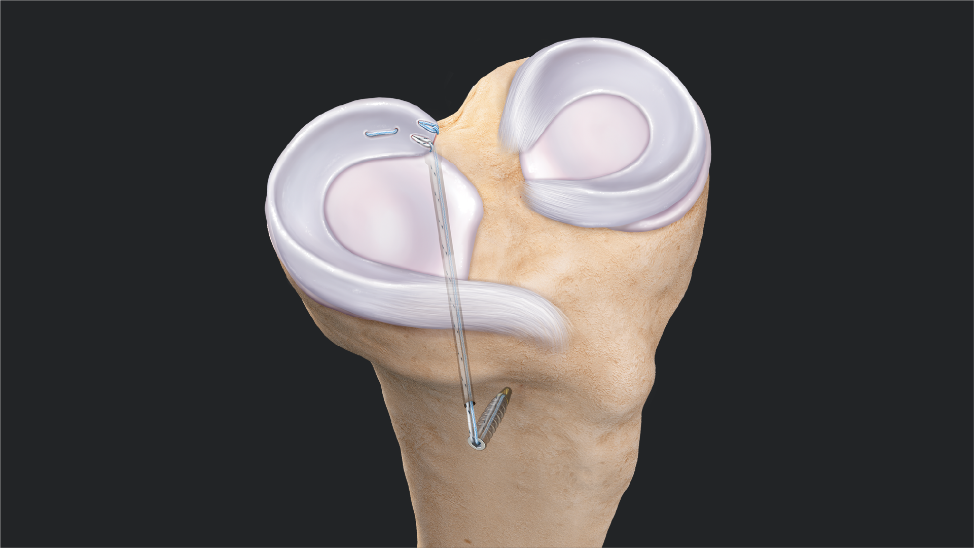 Arthrex - Meniscal Root Repair