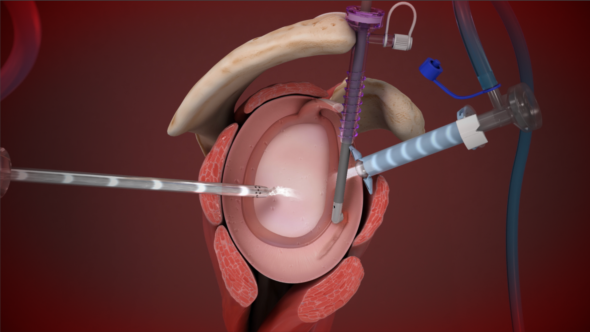 美品 Creek ANGLE'S DEVICE ナイロン プルオーバー XL Arthrex - DualWave™ Arthroscopy Pump Accessories
