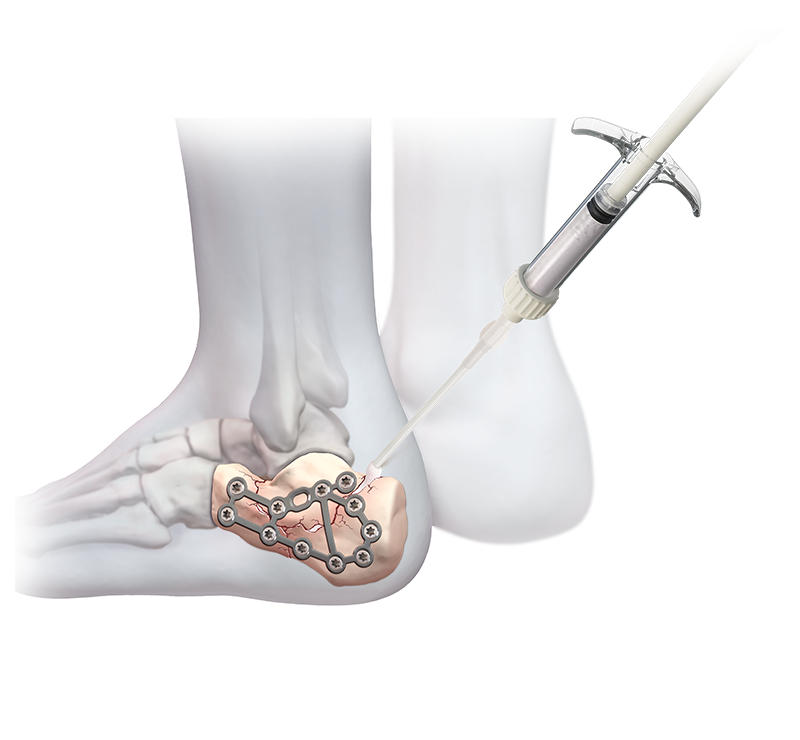 bonefix ultra and bpc-157 ultra bundle product info and reviews BoneSync Fast-Setting Drillable Calcium Phosphate Cement, 5 cc - ABS-3105 Selenious Injection
