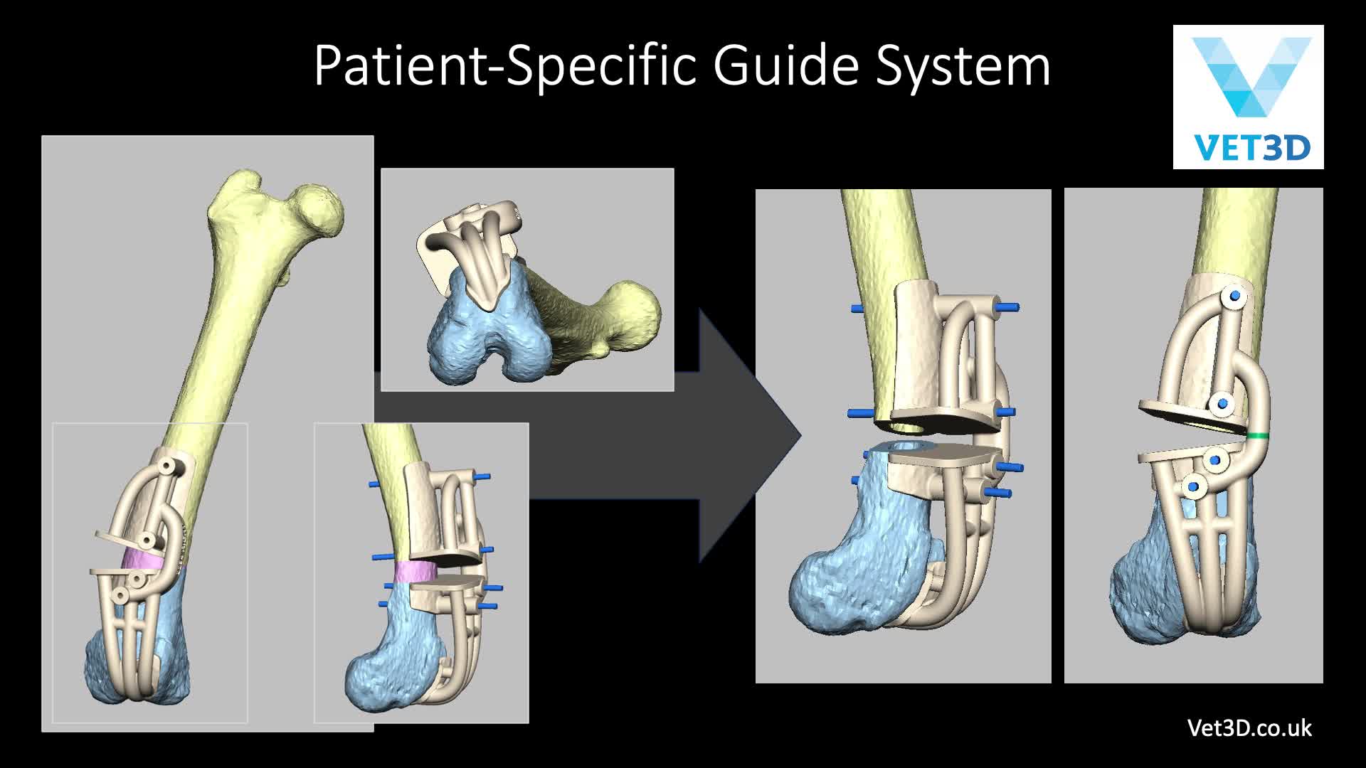 Arthrex Case Planning Considerations For The Distal Femoral Osteotomy