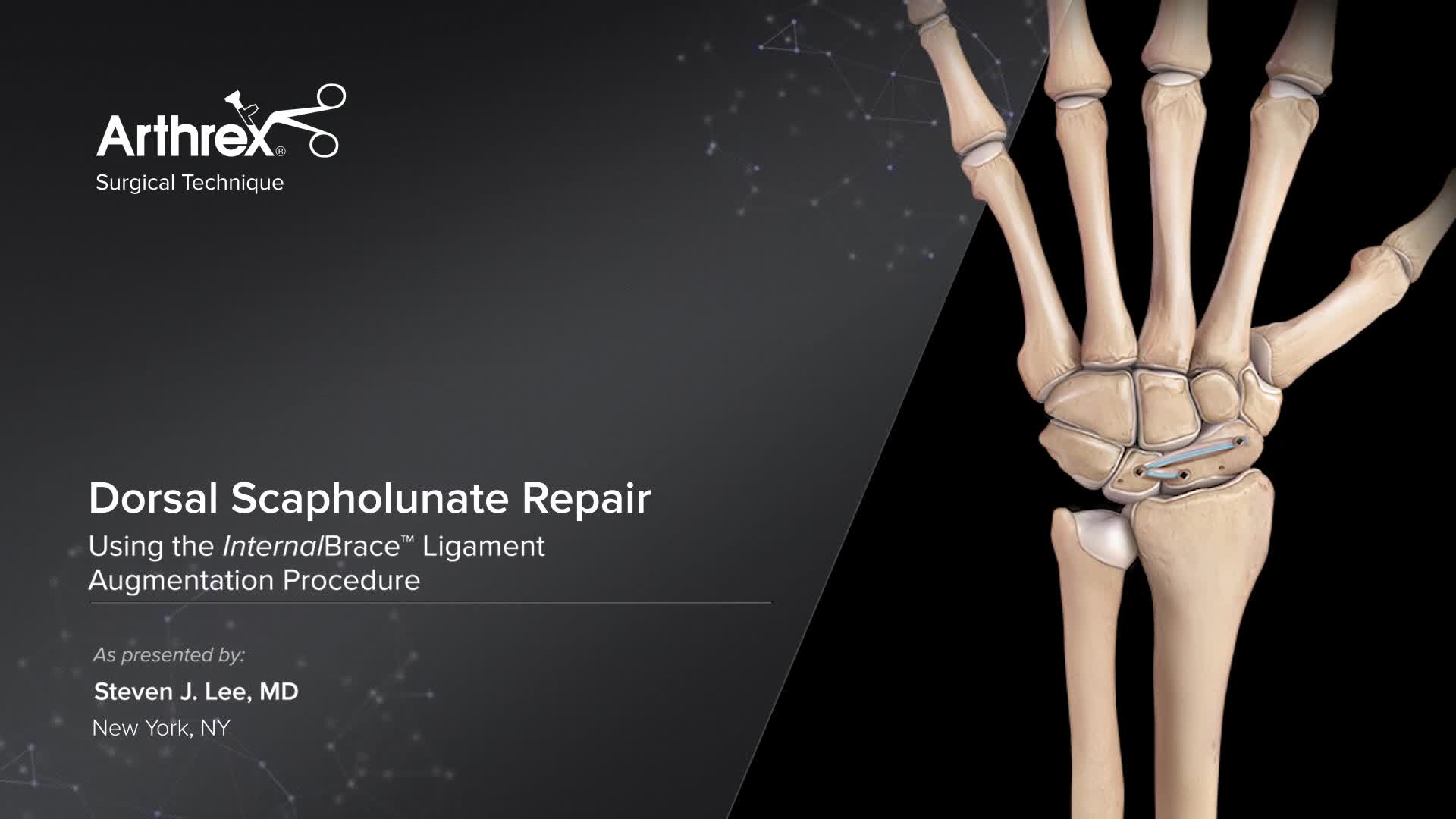 Arthrex Dorsal Scapholunate Repair Using The InternalBrace Ligament