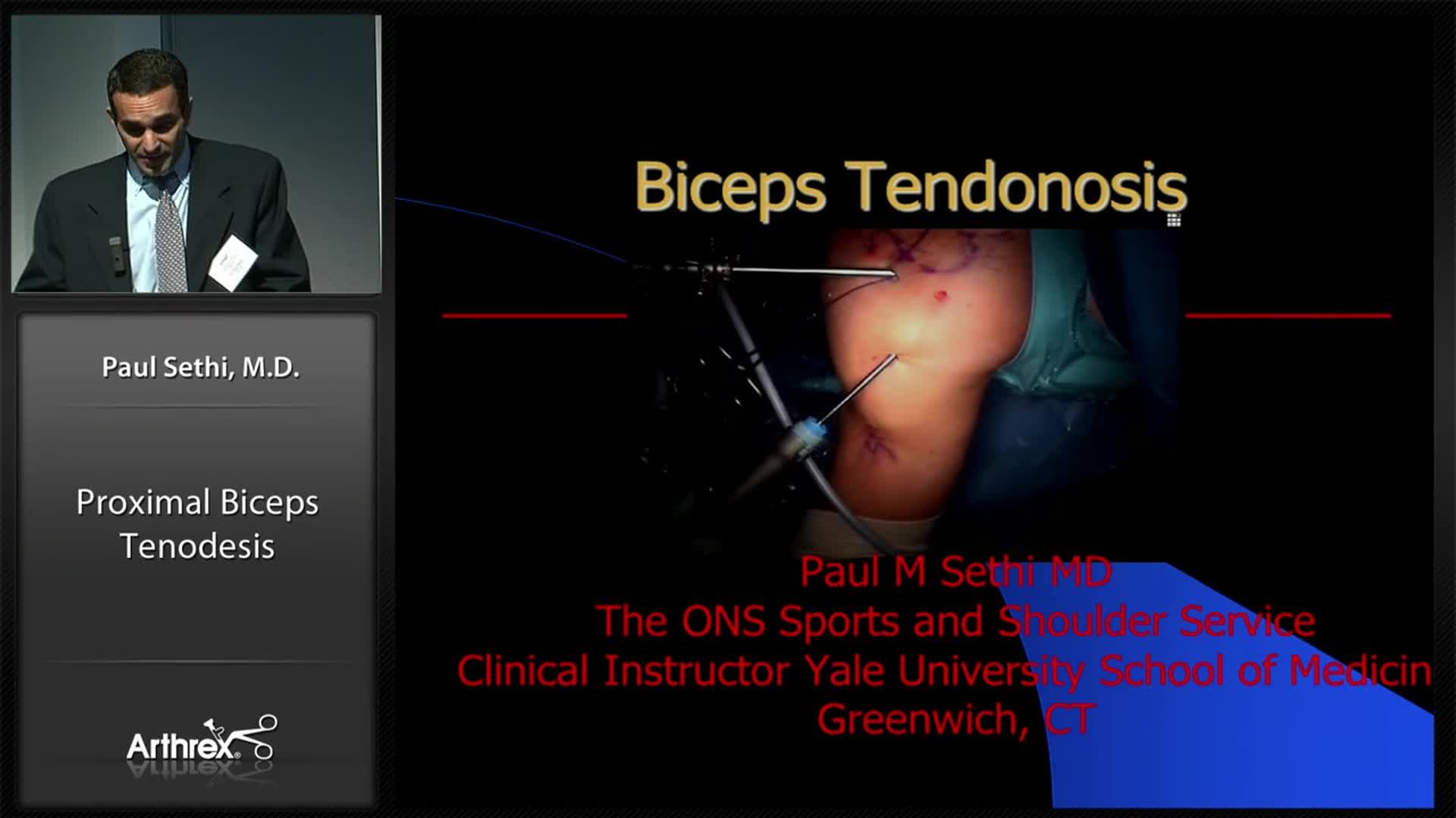 Arthrex Proximal Biceps Tenodesis