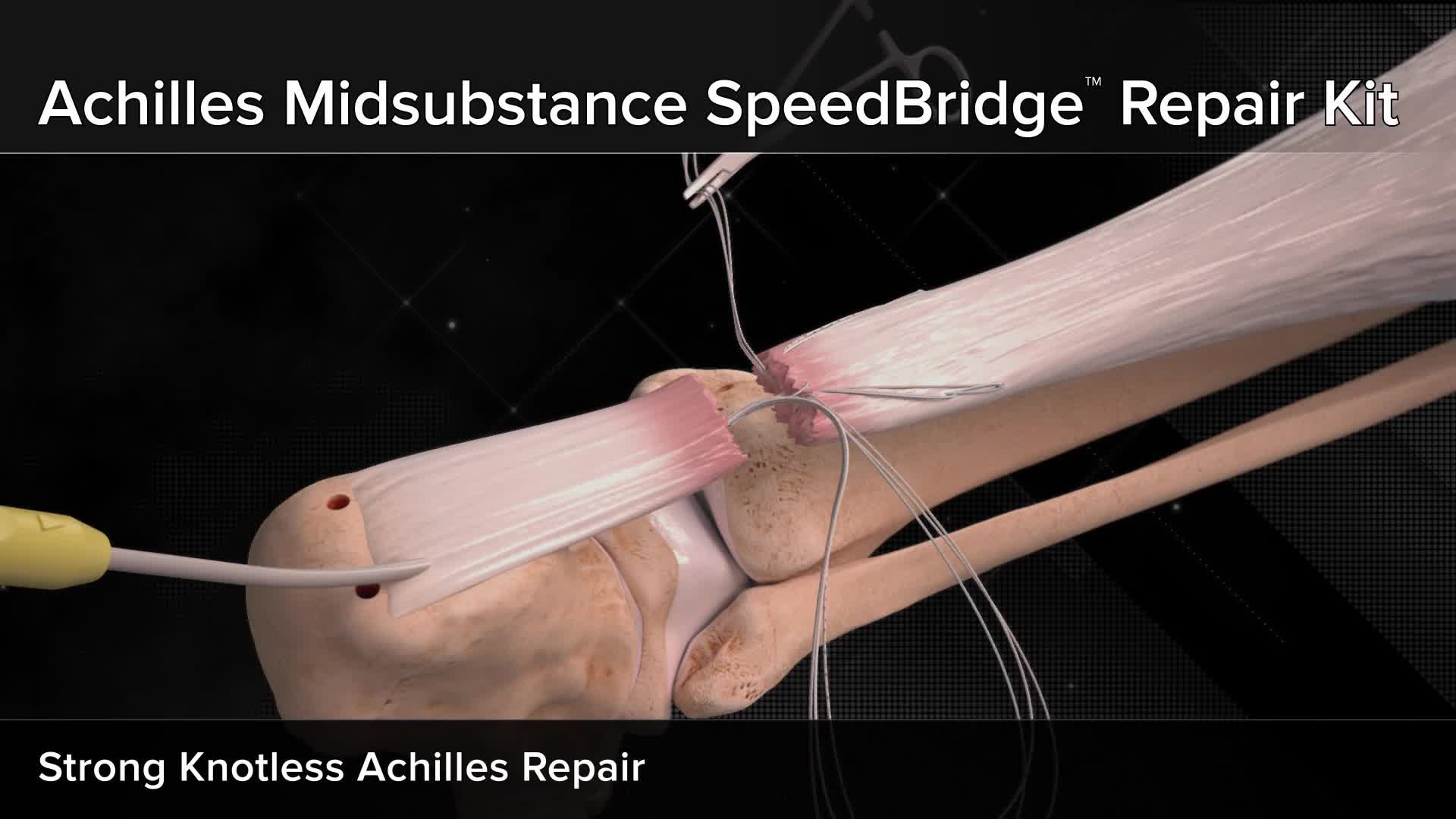 Arthrex Achilles Midsubstance Speedbridge Repair Kit