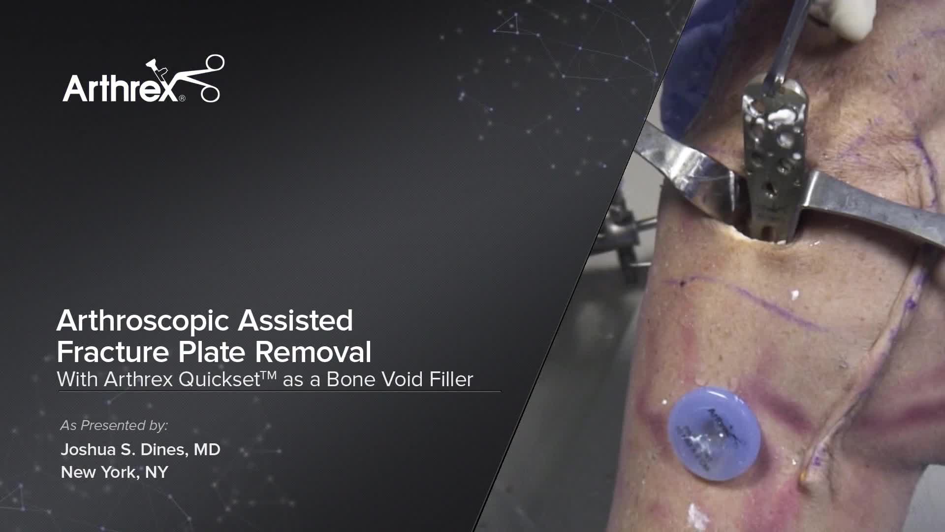 Arthrex Arthroscopic Assisted Fracture Plate Removal With Arthrex