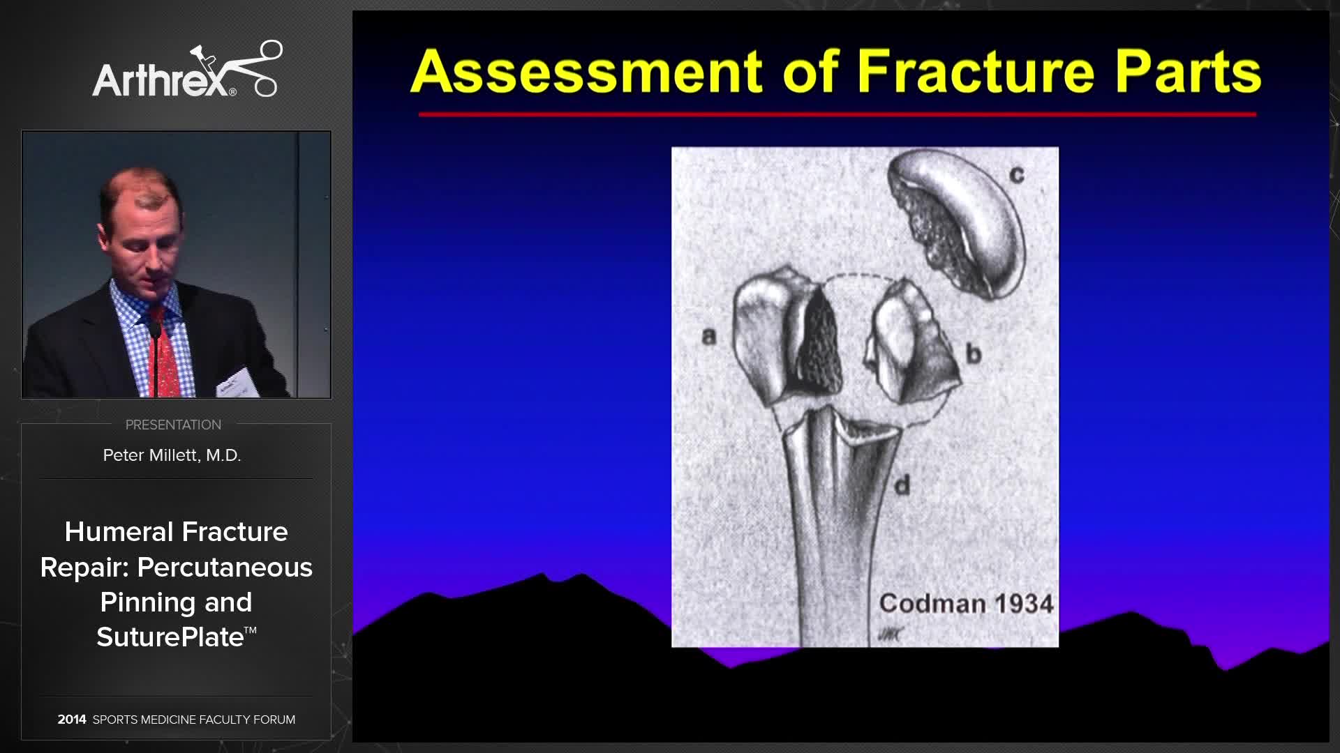 Arthrex Humeral Fracture Repair Percutaneous Pinning And SuturePlate