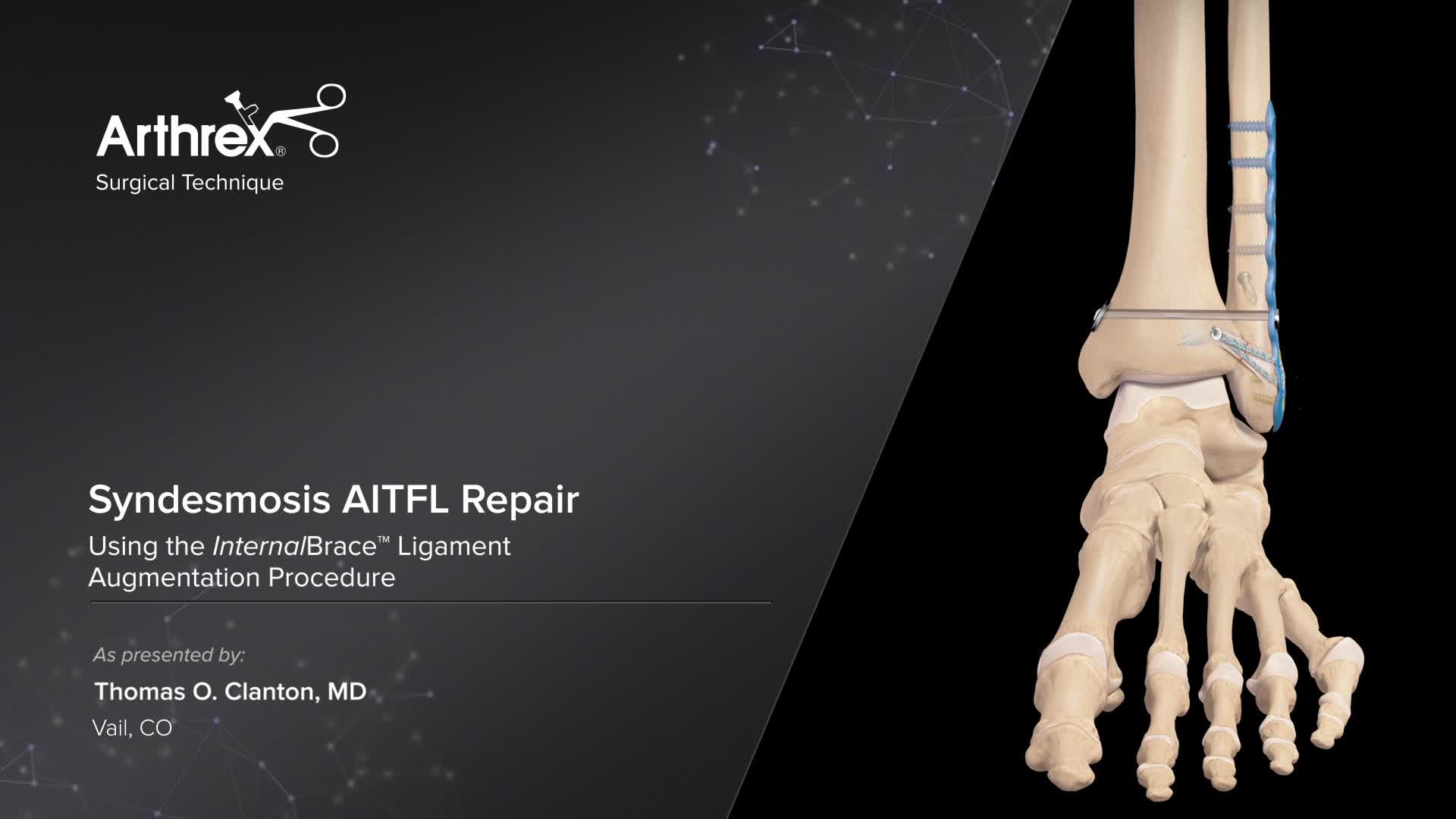 Arthrex Syndesmosis Aitfl Repair Using The Internalbrace Procedure