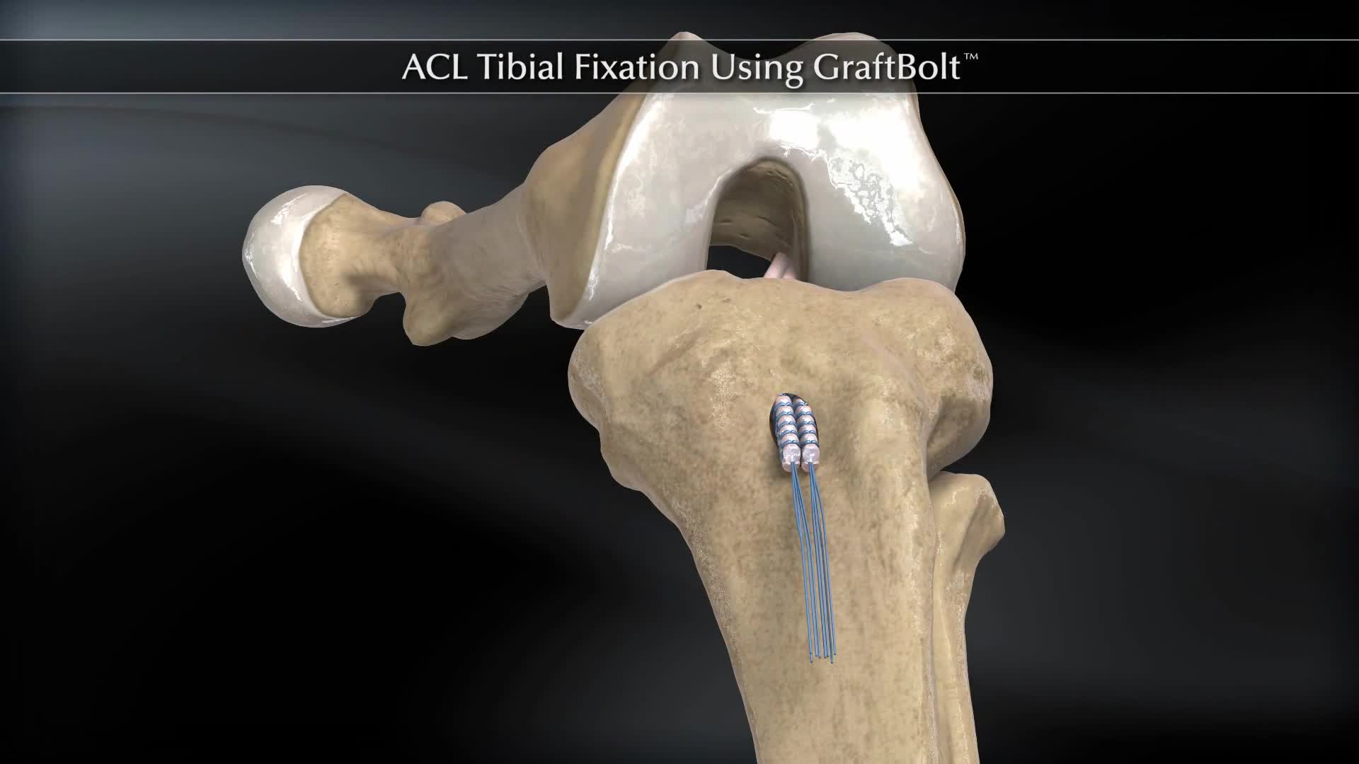 Arthrex ACL Tibial Fixation Using GraftBolt