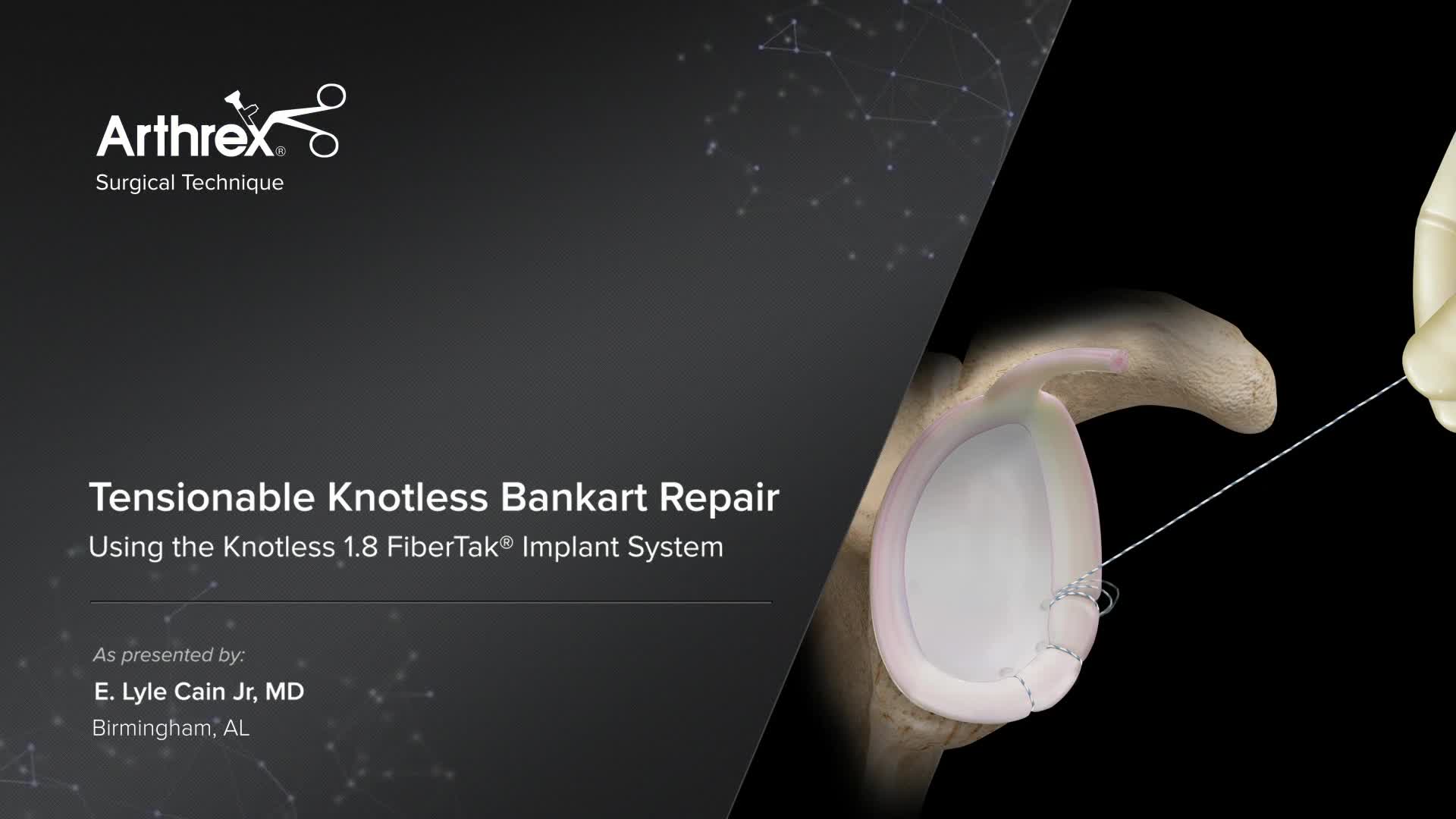 Arthrex Tensionable Knotless Bankart Repair Using The Knotless