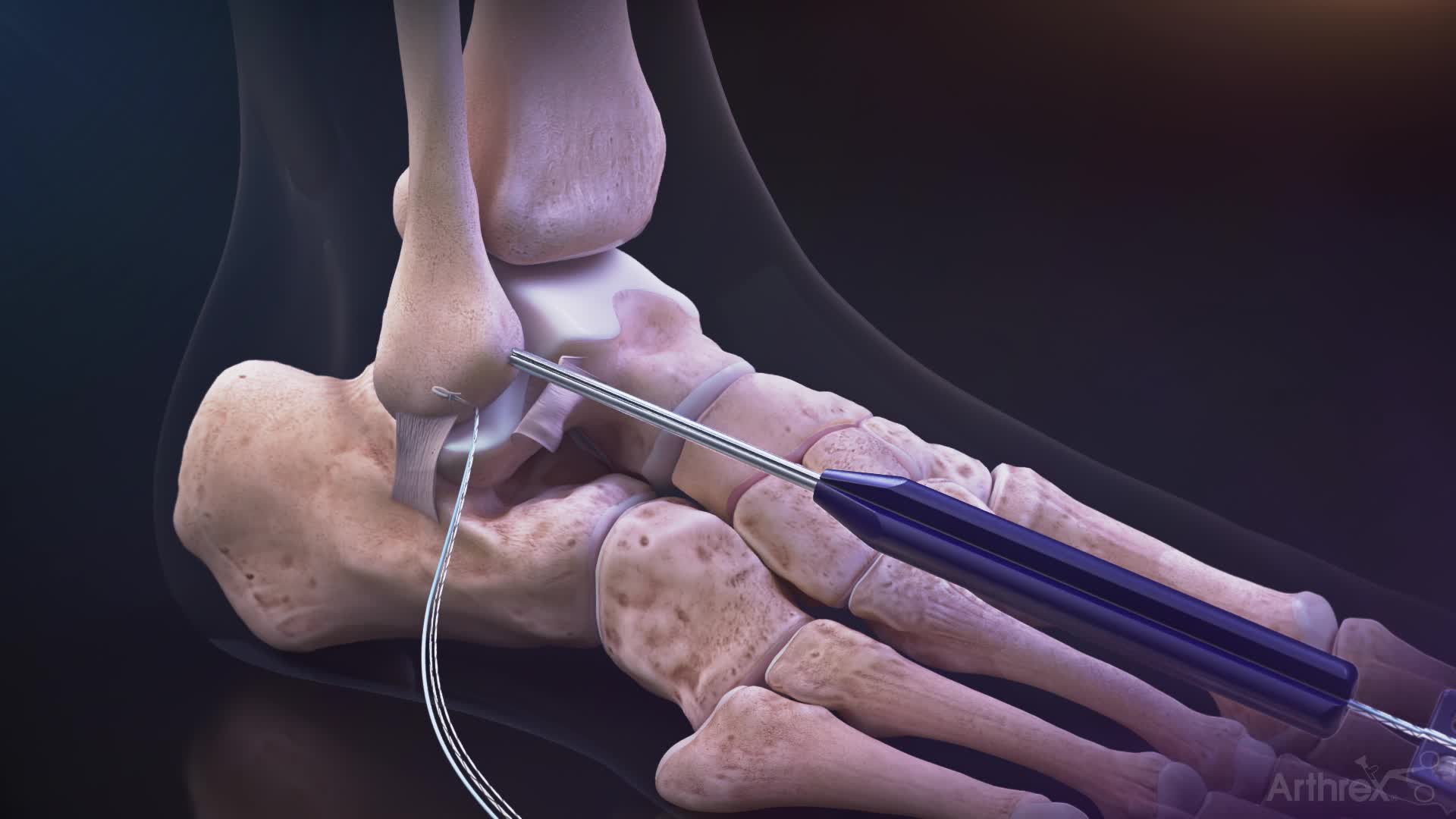 Arthrex InternalBrace Repair With DX Knotless FiberTak Anchors