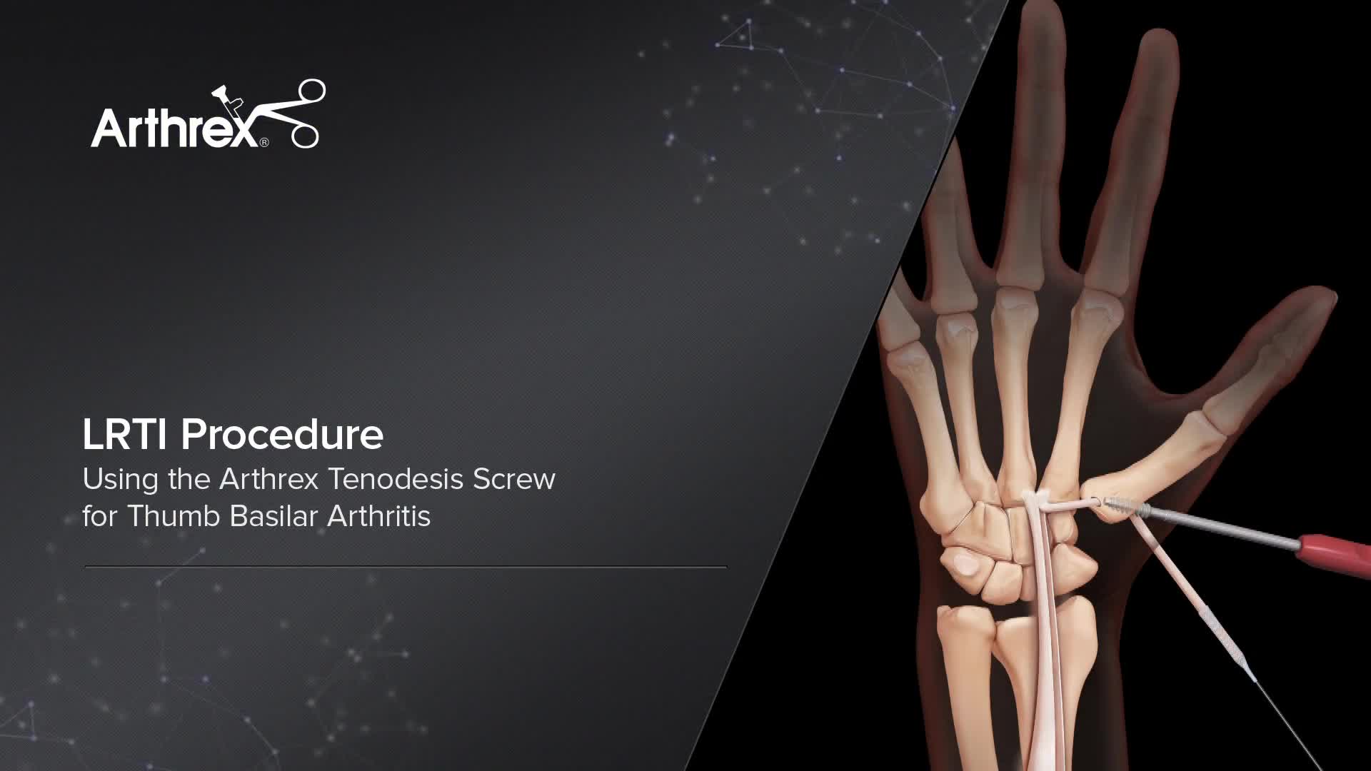 Arthrex Lrti Procedure Using The Arthrex Tenodesis Screw For Thumb