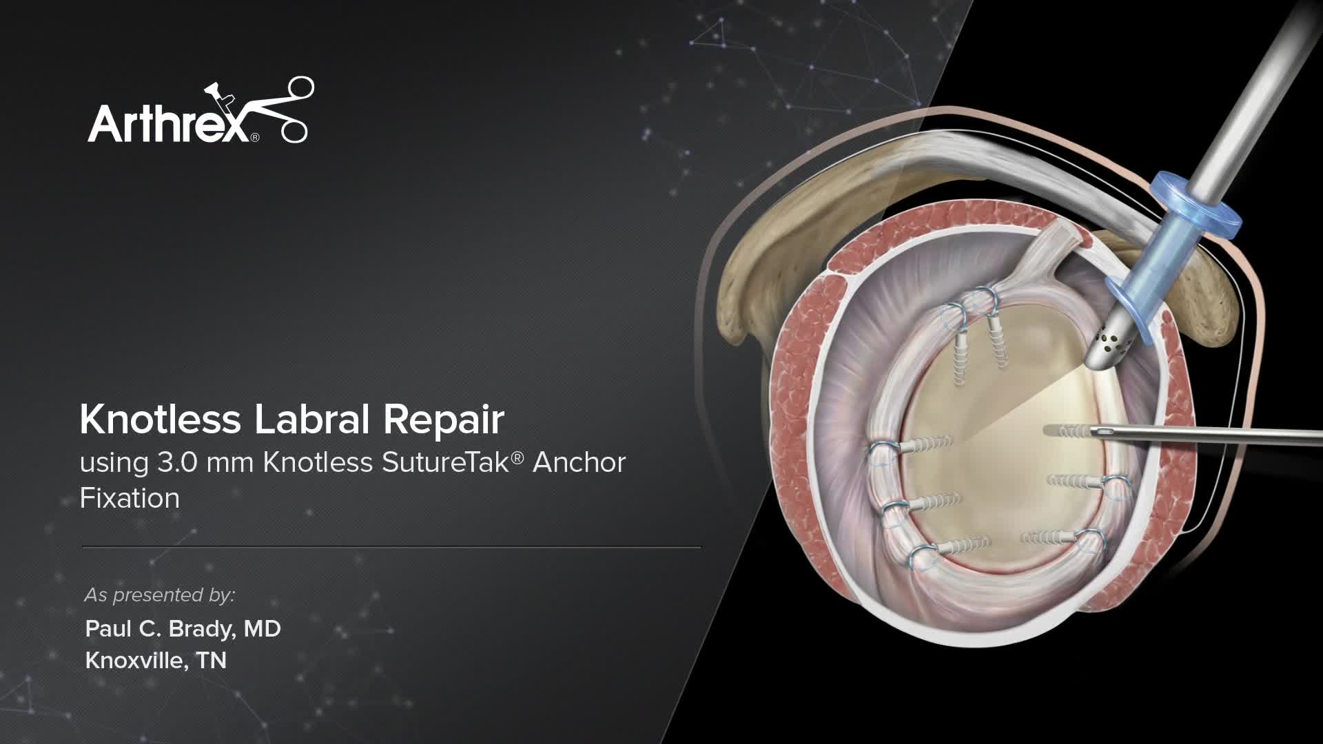 Arthrex Knotless Labral Repair Using Mm Knotless Suturetak