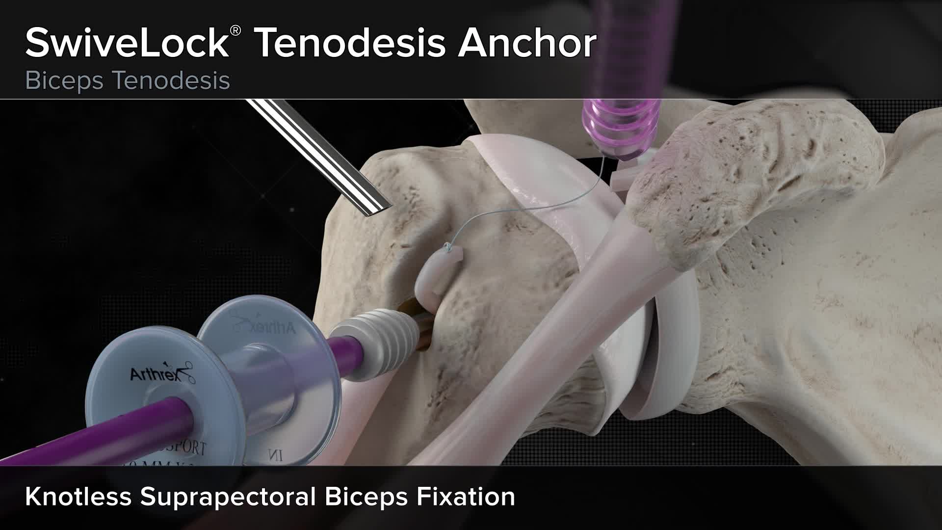 Arthrex SwiveLock Tenodesis Anchor Biceps Tenodesis