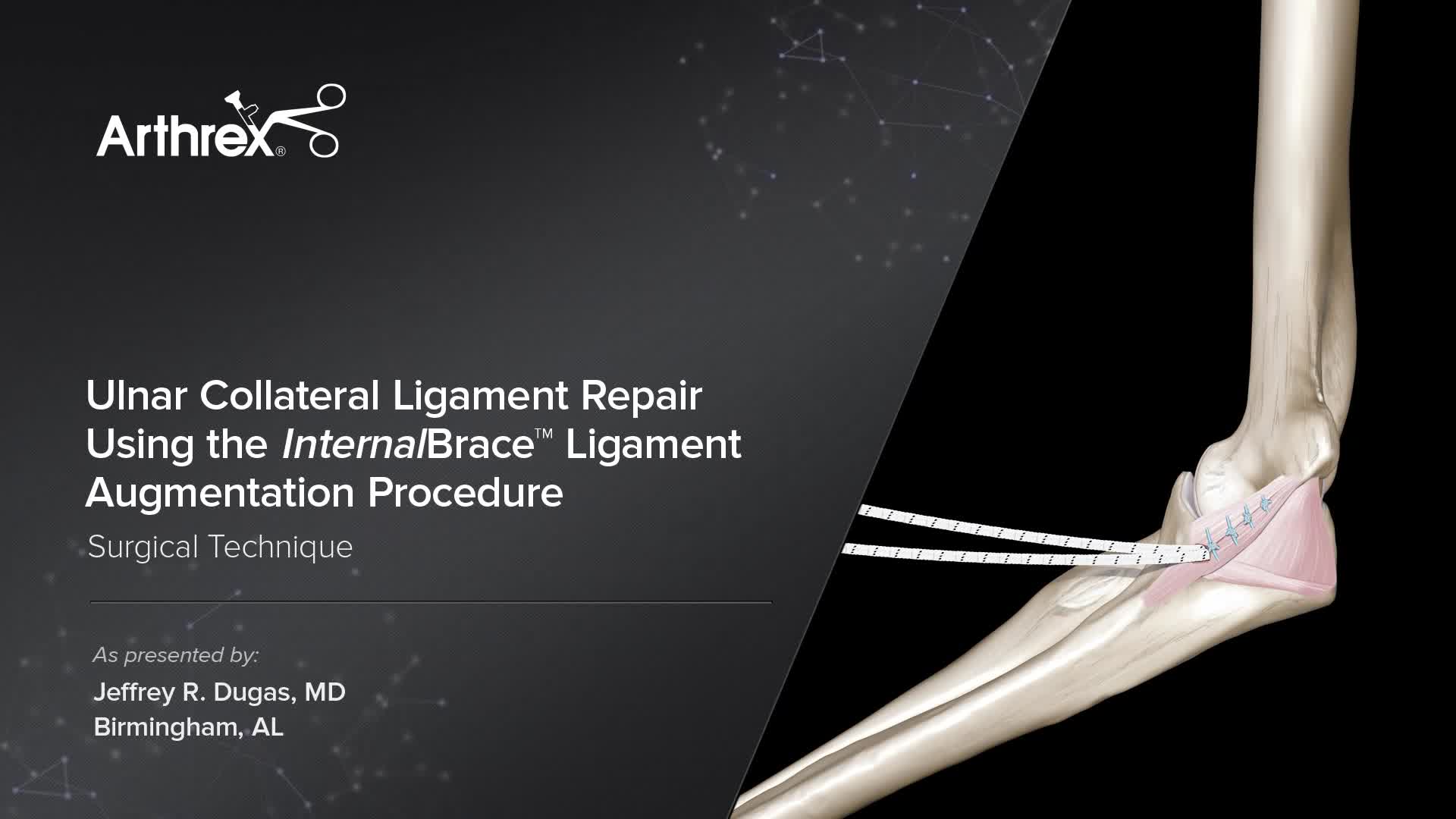 Arthrex UCL Repair Using The InternalBrace System