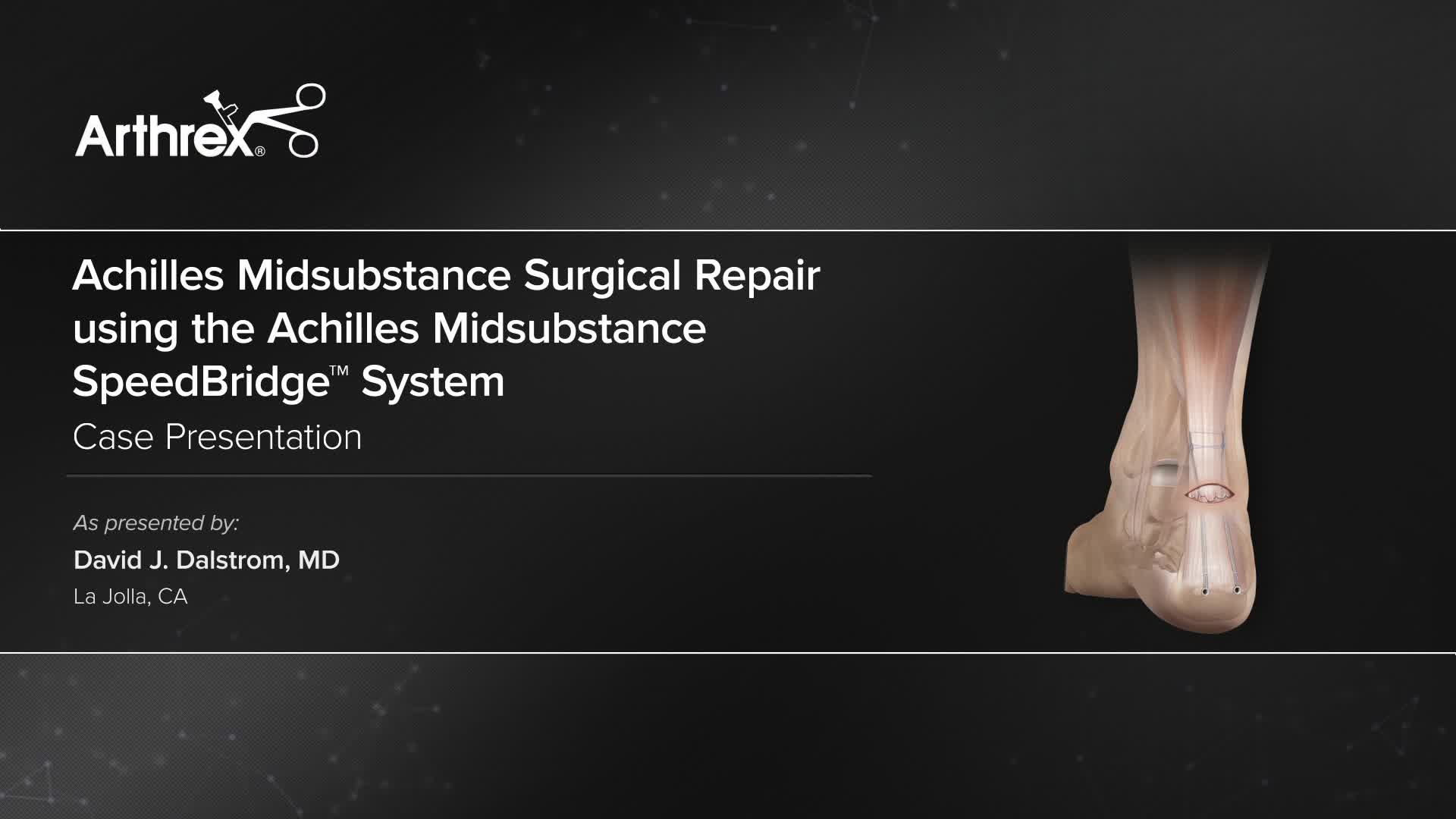 Arthrex Achilles Midsubstance Surgical Repair Using The Achilles Midsubstance Speedbridge System