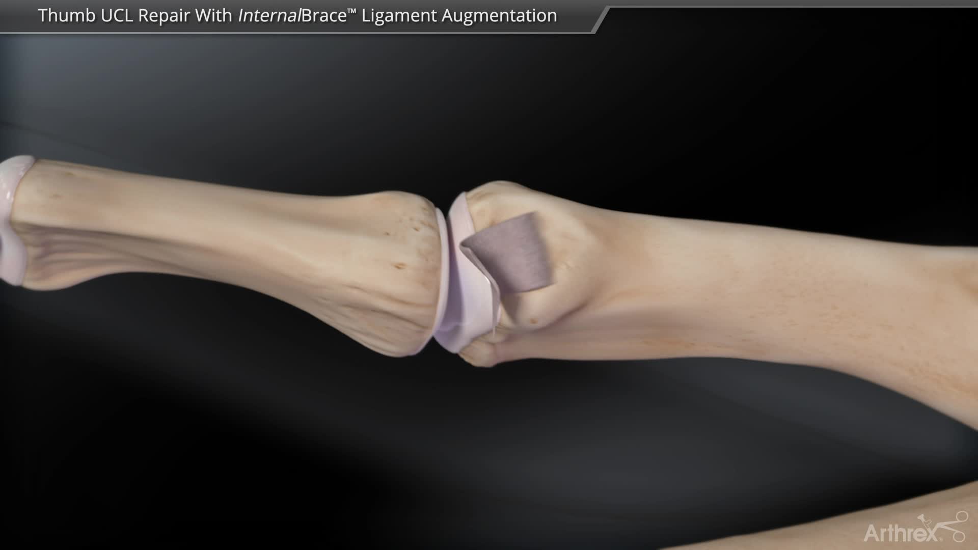 Arthrex Thumb UCL Repair And Reconstruction With InternalBrace