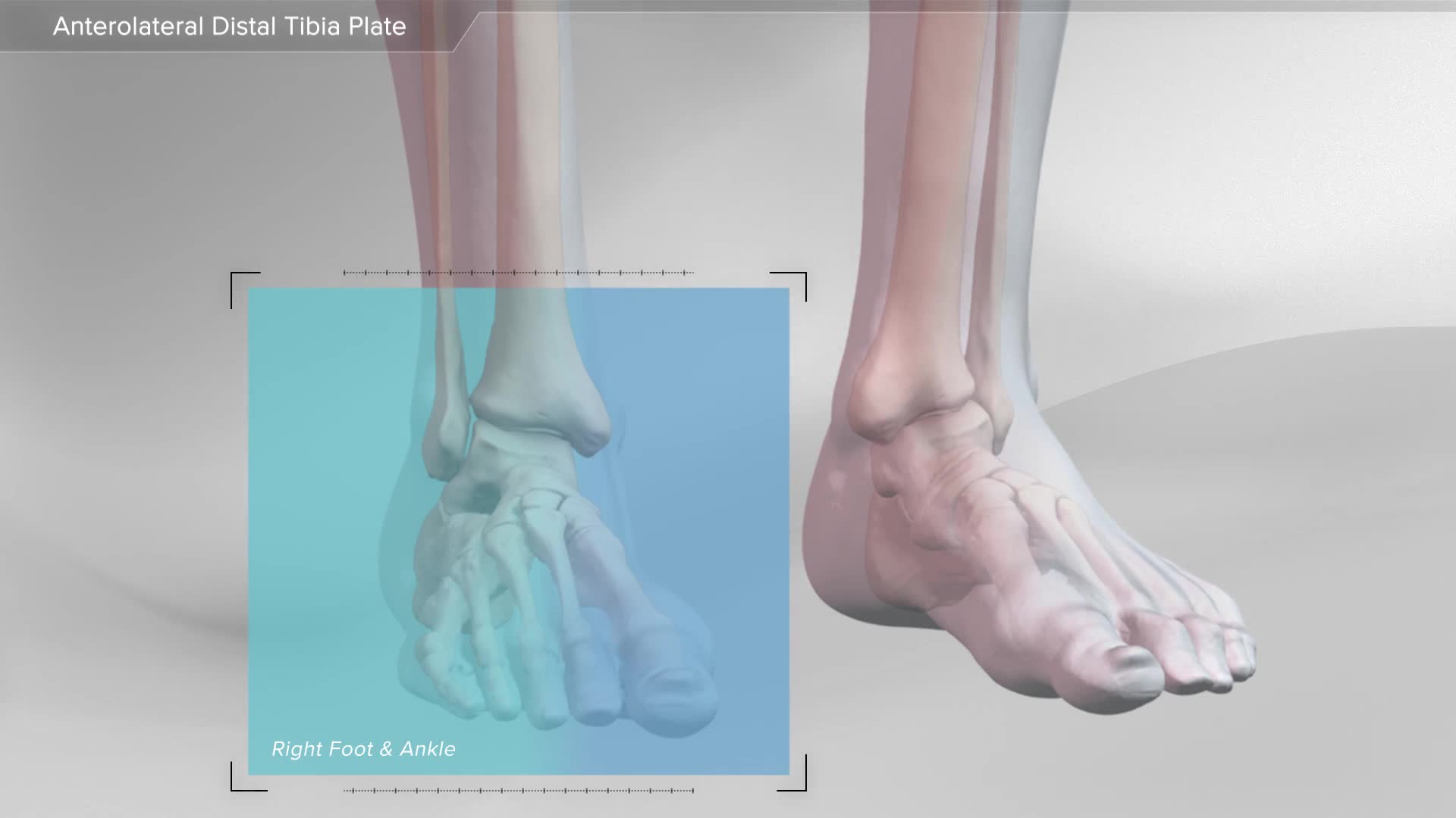 Arthrex Distal Tibia Plating System