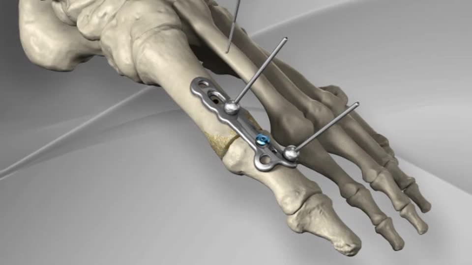 Arthrex Interphalangeal Joint Fusion