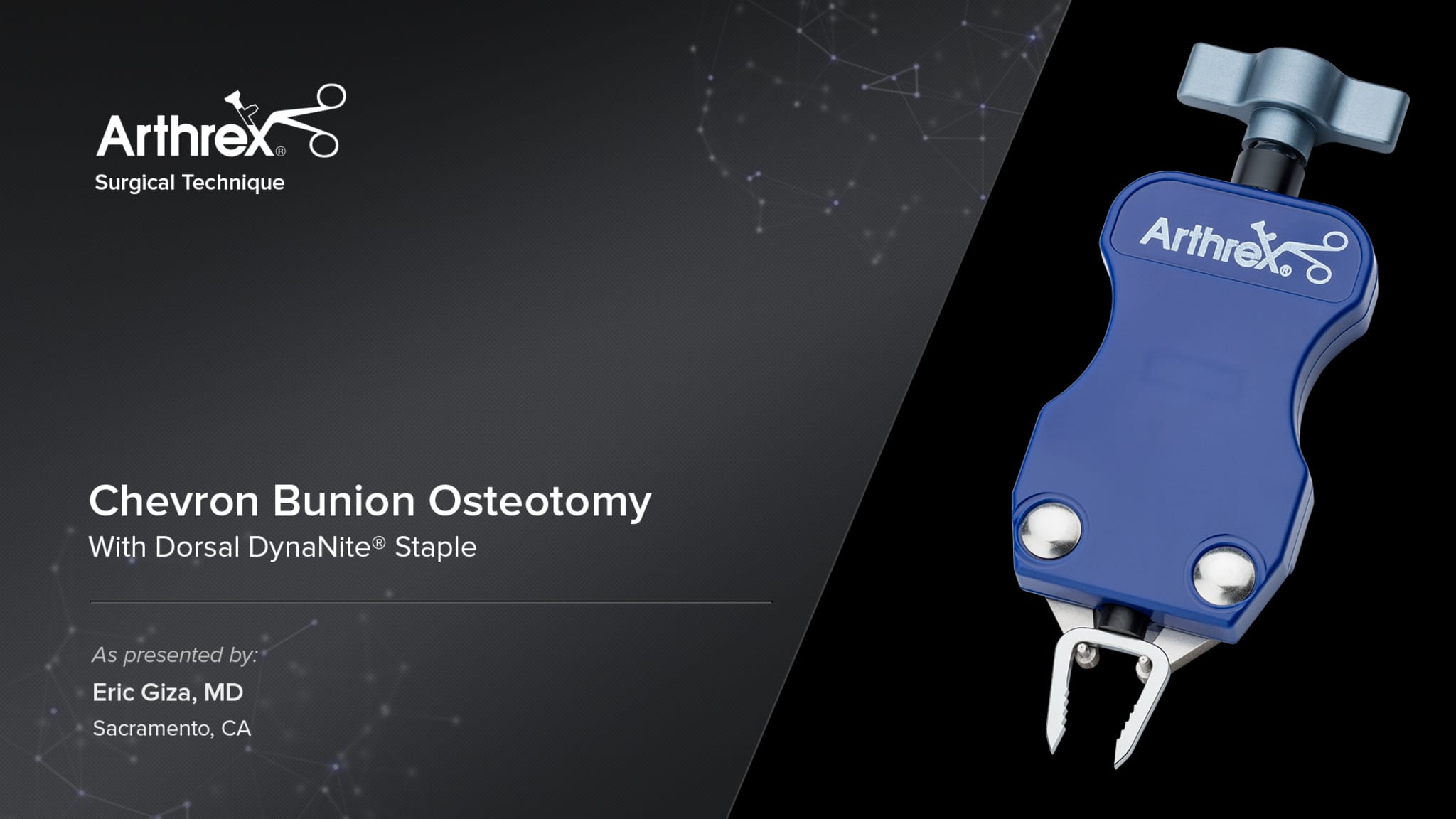 Chevron Bunion Osteotomy With Dorsal DynaNite® Staple
