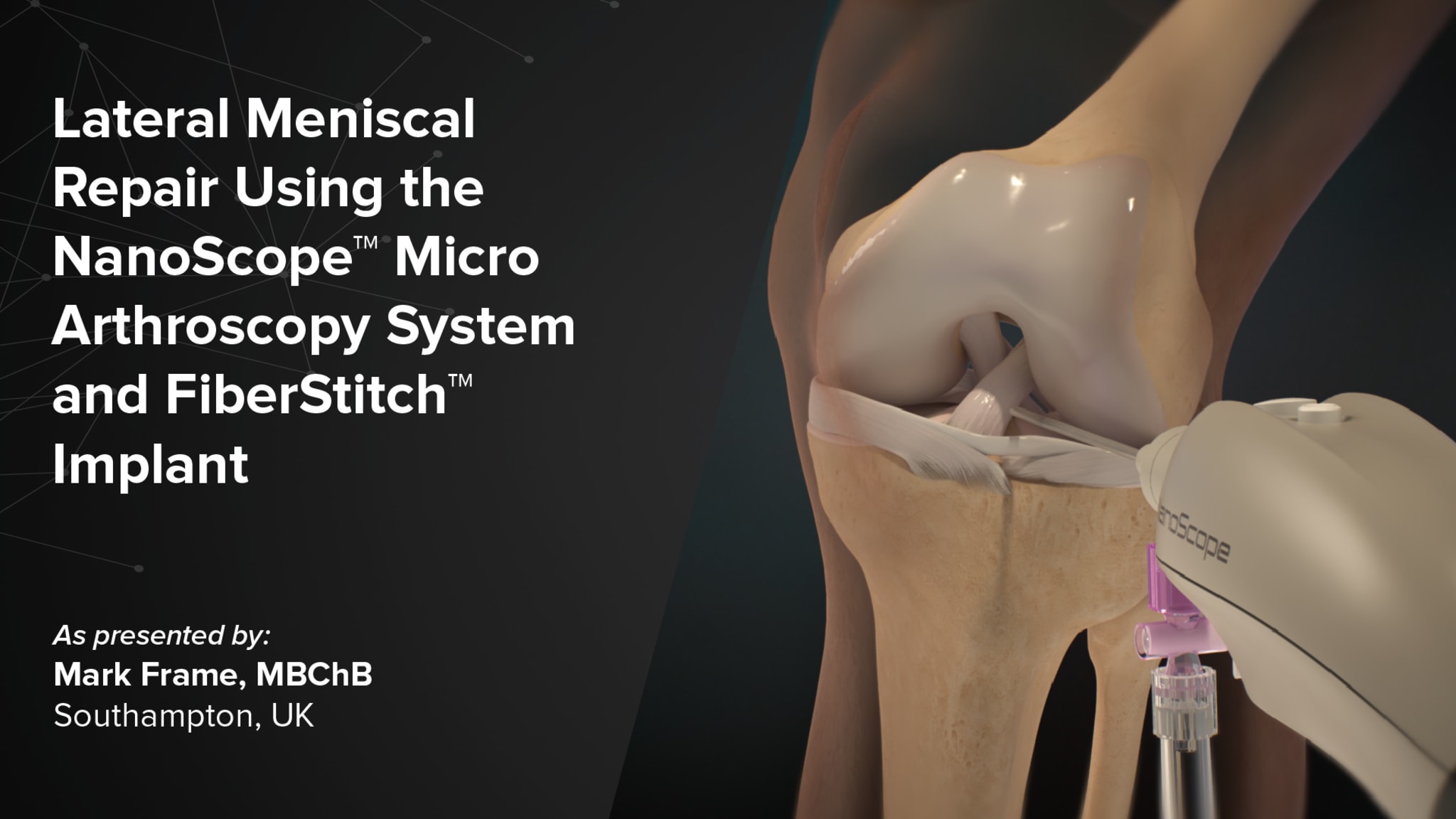 Lateral Meniscal Repair Using the NanoScope™ Micro Arthroscopy System and FiberStitch™ Implant