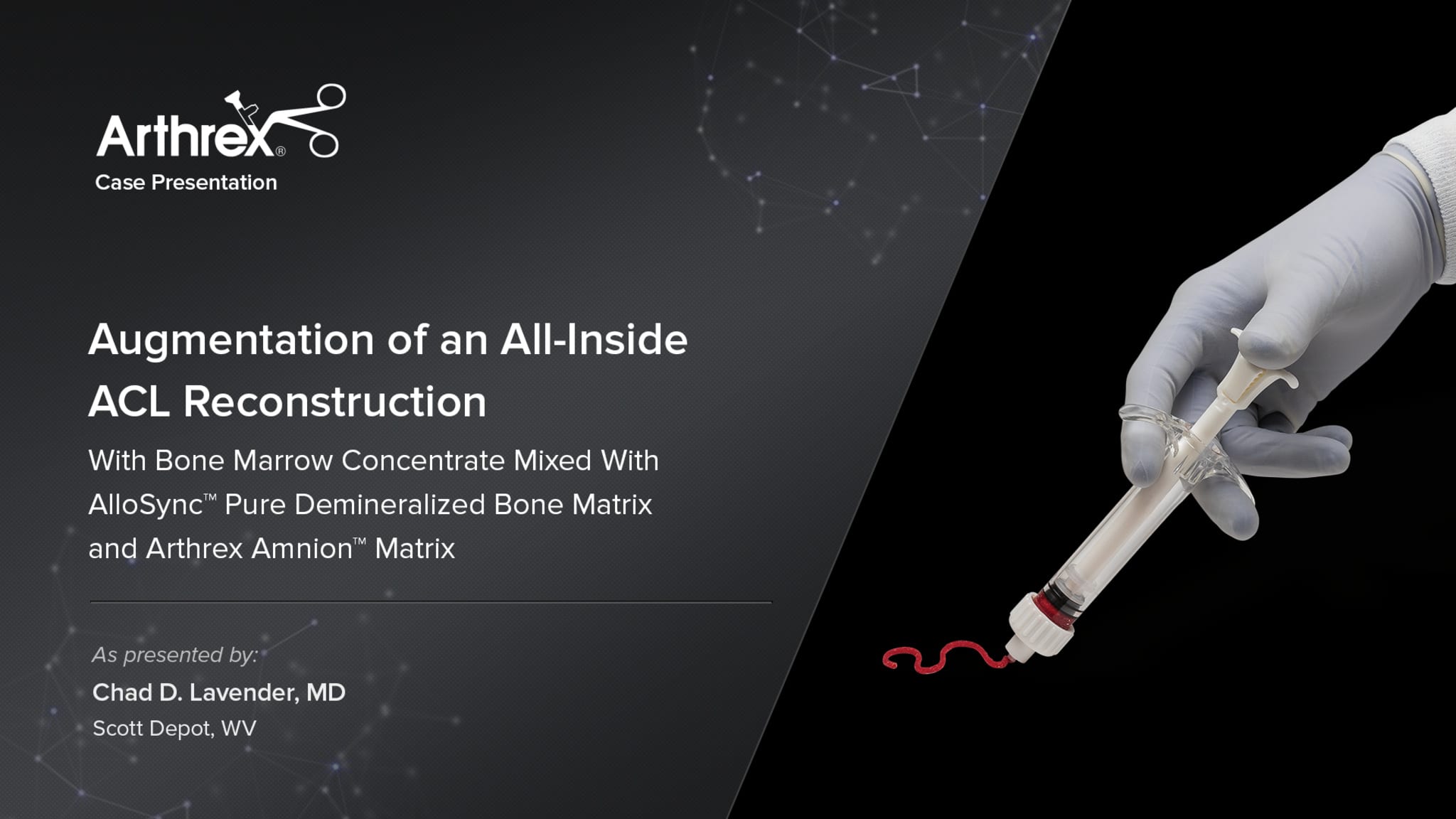 All-Inside ACL Reconstruction Augmented With AlloSync™ Pure