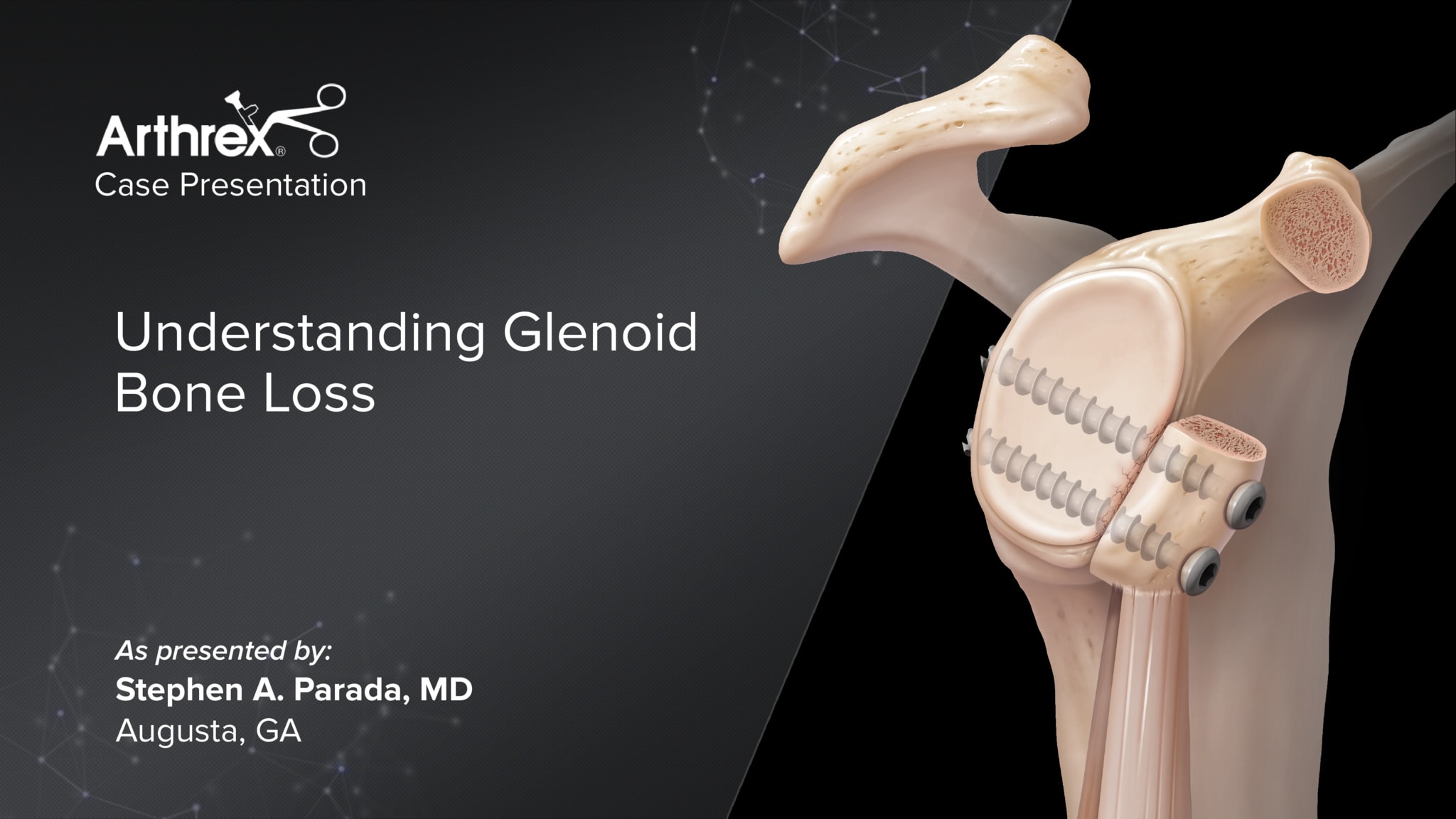 Understanding Glenoid Bone Loss