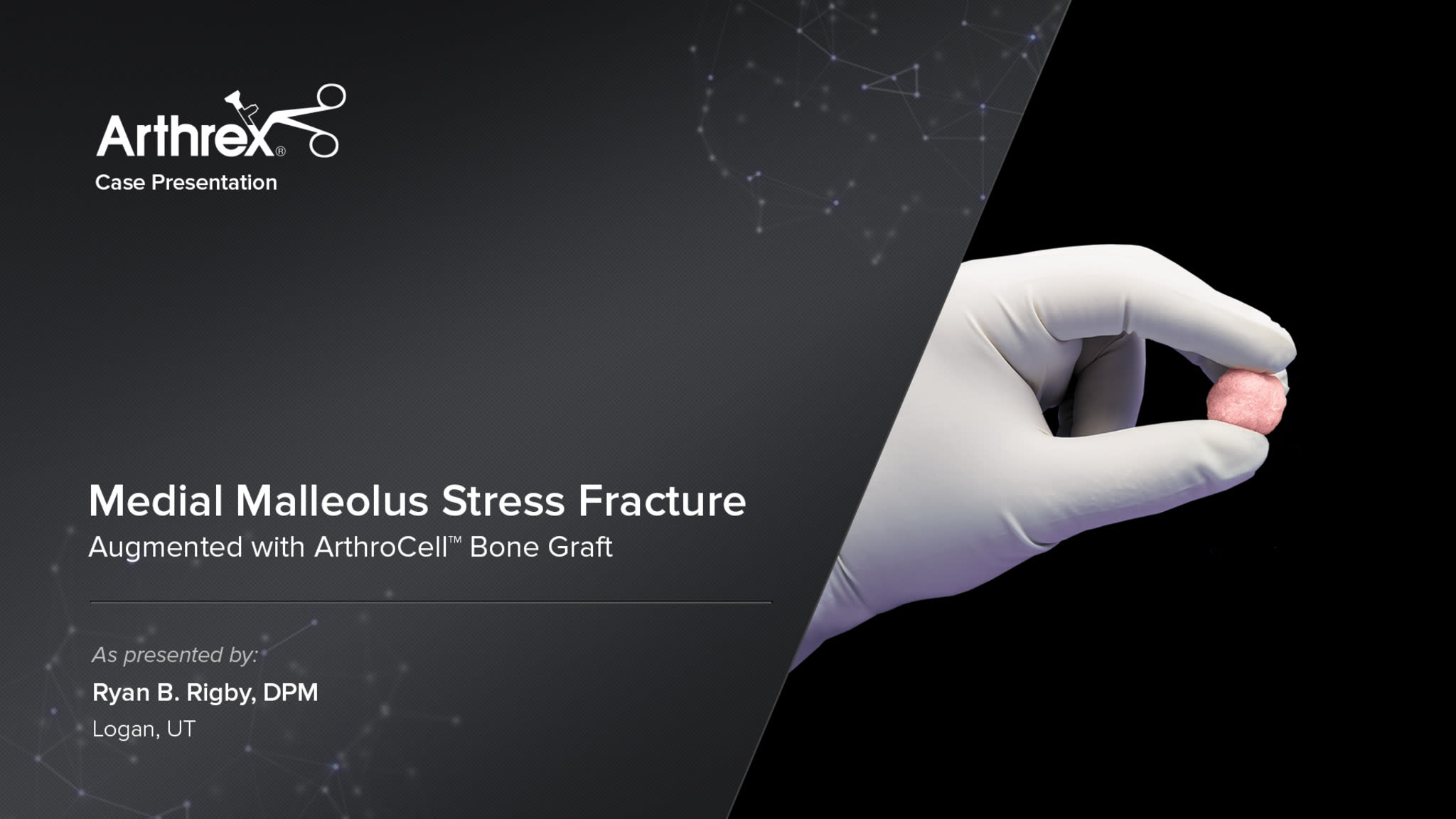 Medial Malleolus Stress Fracture Augmented With ArthroCell™ Bone Graft