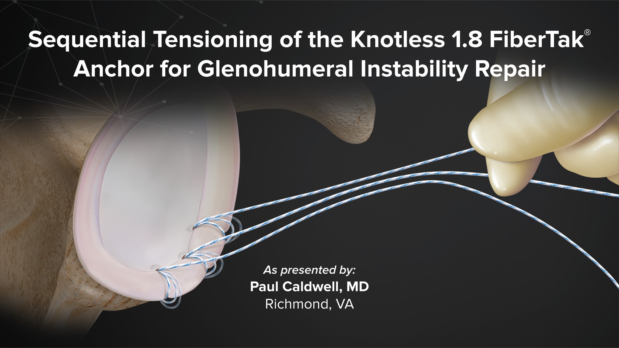 Sequential Tensioning of the Knotless 1.8 FiberTak® Anchor for Glenohumeral Instability Repair