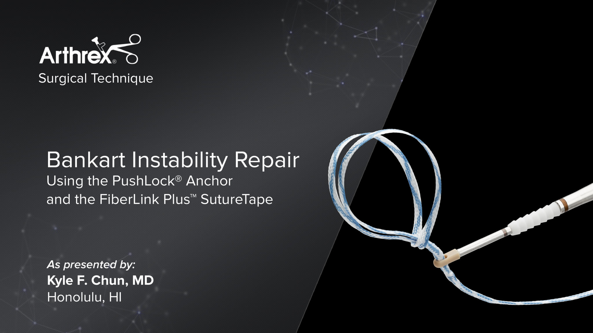 Bankart Instability Repair Using the PushLock® Anchor and the FiberLink Plus™ SutureTape