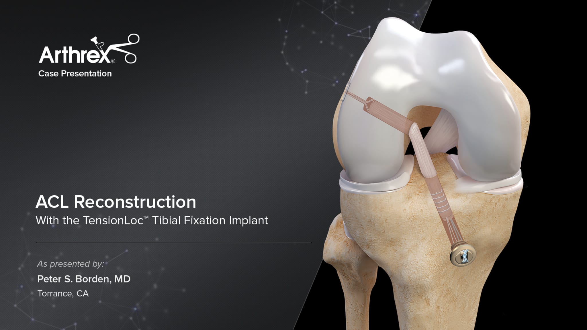 ACL Reconstruction With the TensionLoc™ Tibial Fixation Implant