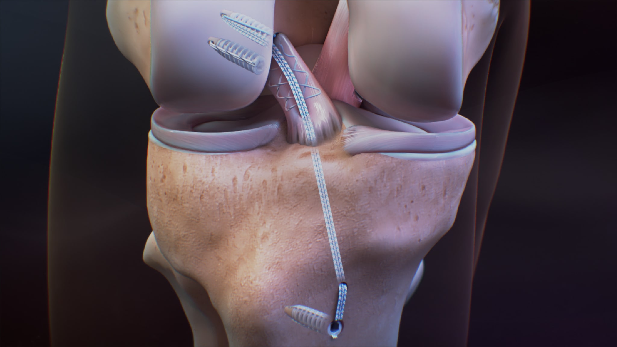 ACL Preservation With the SwiveLock® ACL Repair Kit