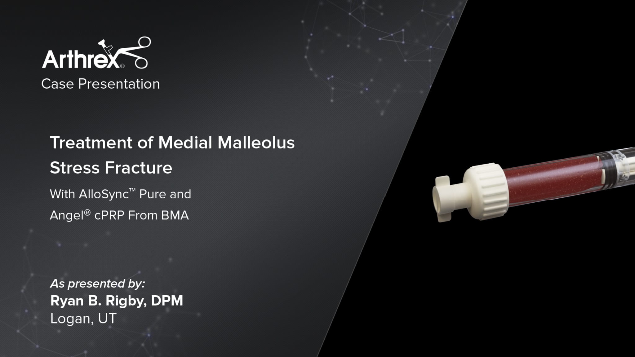 Treatment of Medial Malleolus Stress Fracture With AlloSync™ Pure and Angel® cPRP From BMA