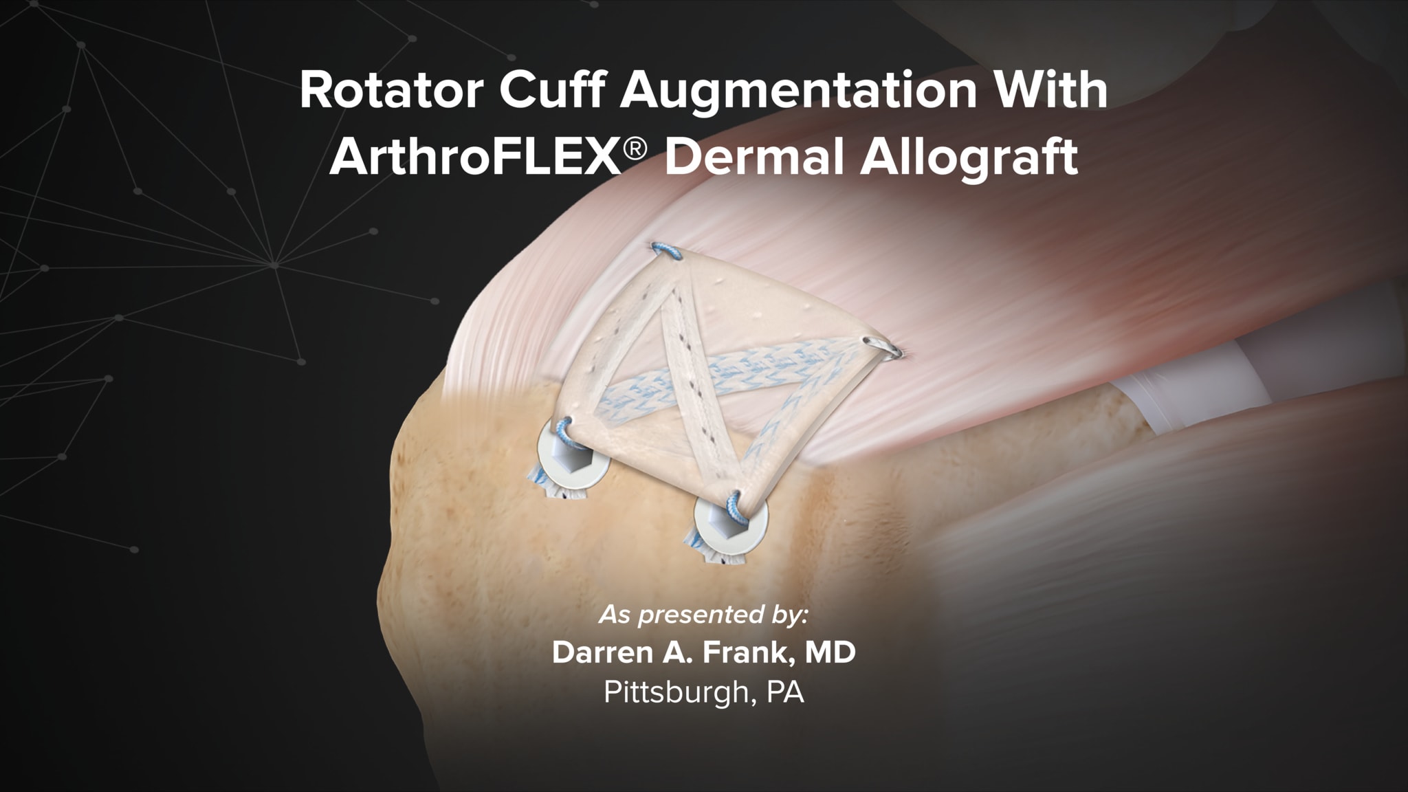 Rotator Cuff Augmentation With ArthroFLEX® Dermal Allograft