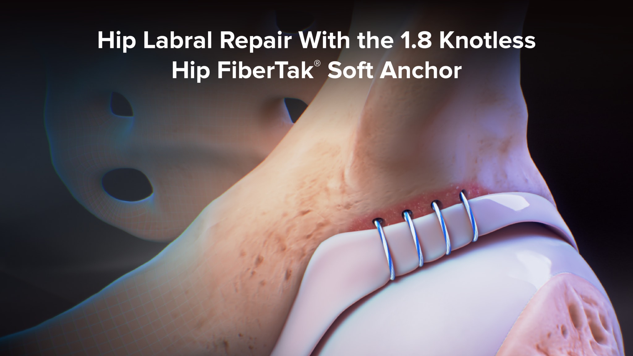Hip Labral Repair Using the Knotless 1.8 Hip FiberTak® Soft Anchor and an Inversion Stitch 