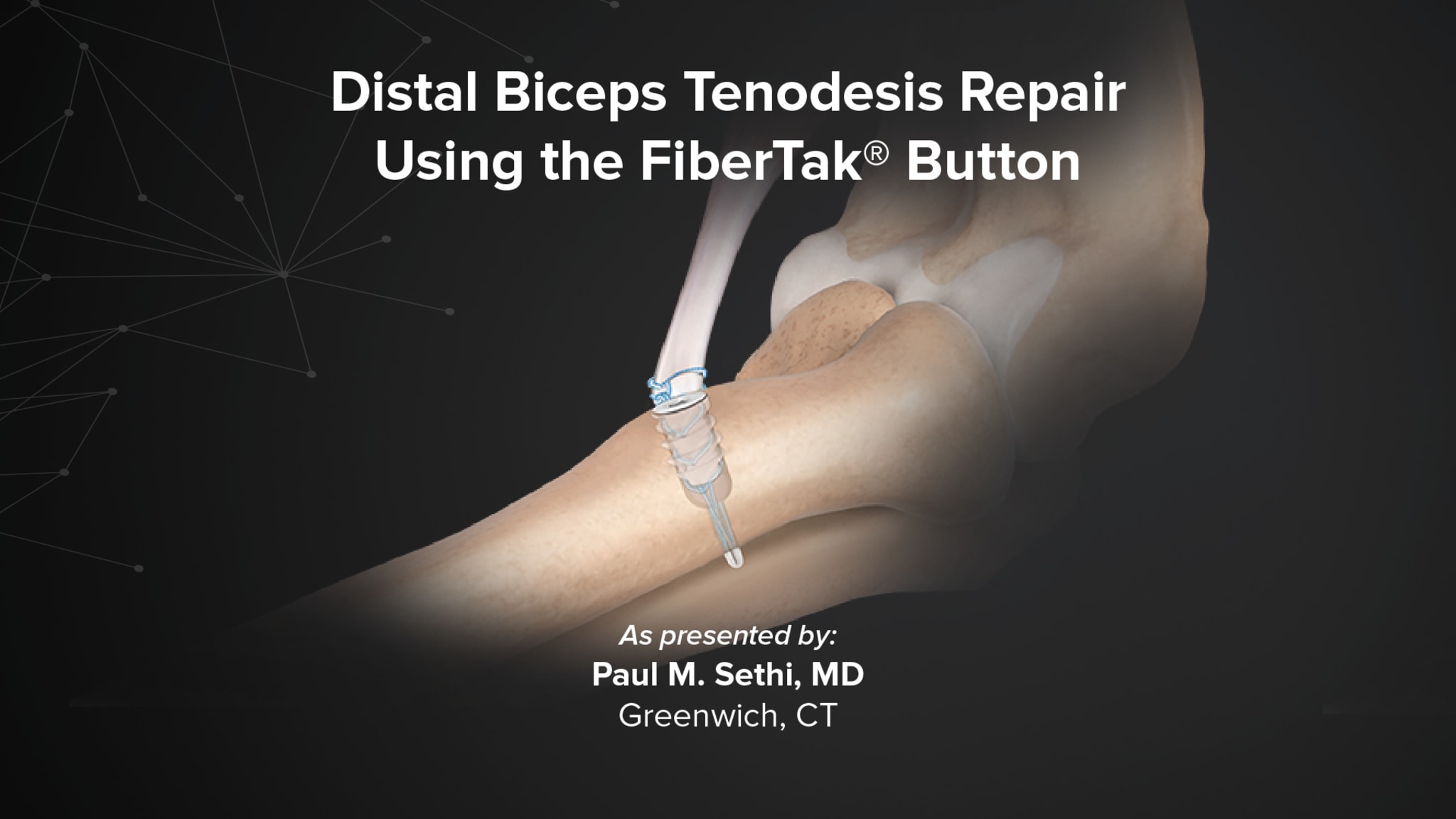 Distal Biceps Tenodesis Repair Using the FiberTak® Button