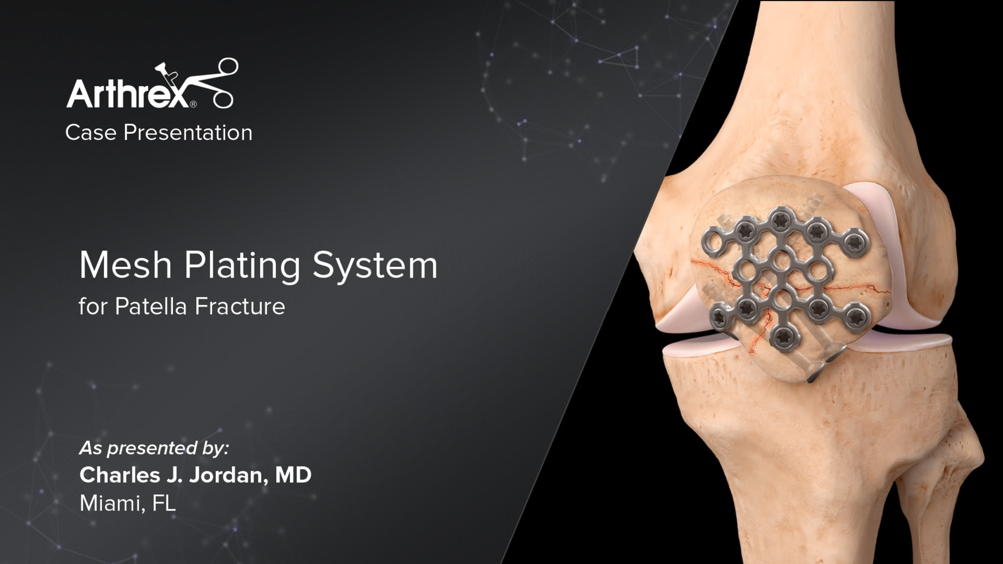Mesh Plating System for Patella Fracture