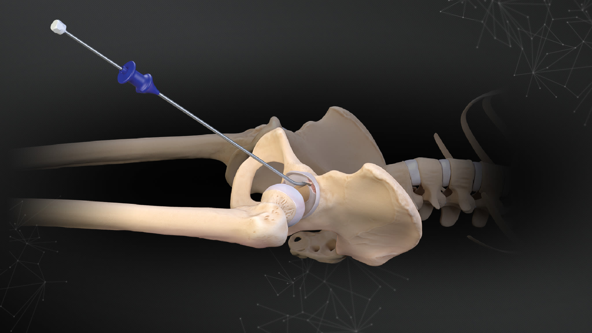 AutoCart™ Procedure in the Hip: Applications and Technique With the GraftNet™ Collector