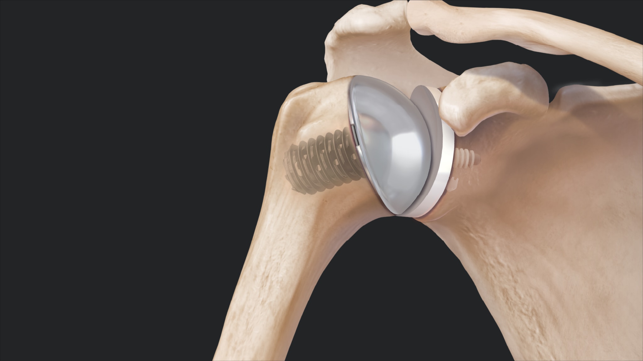 Eclipse™ Stemless Shoulder Arthroplasty System