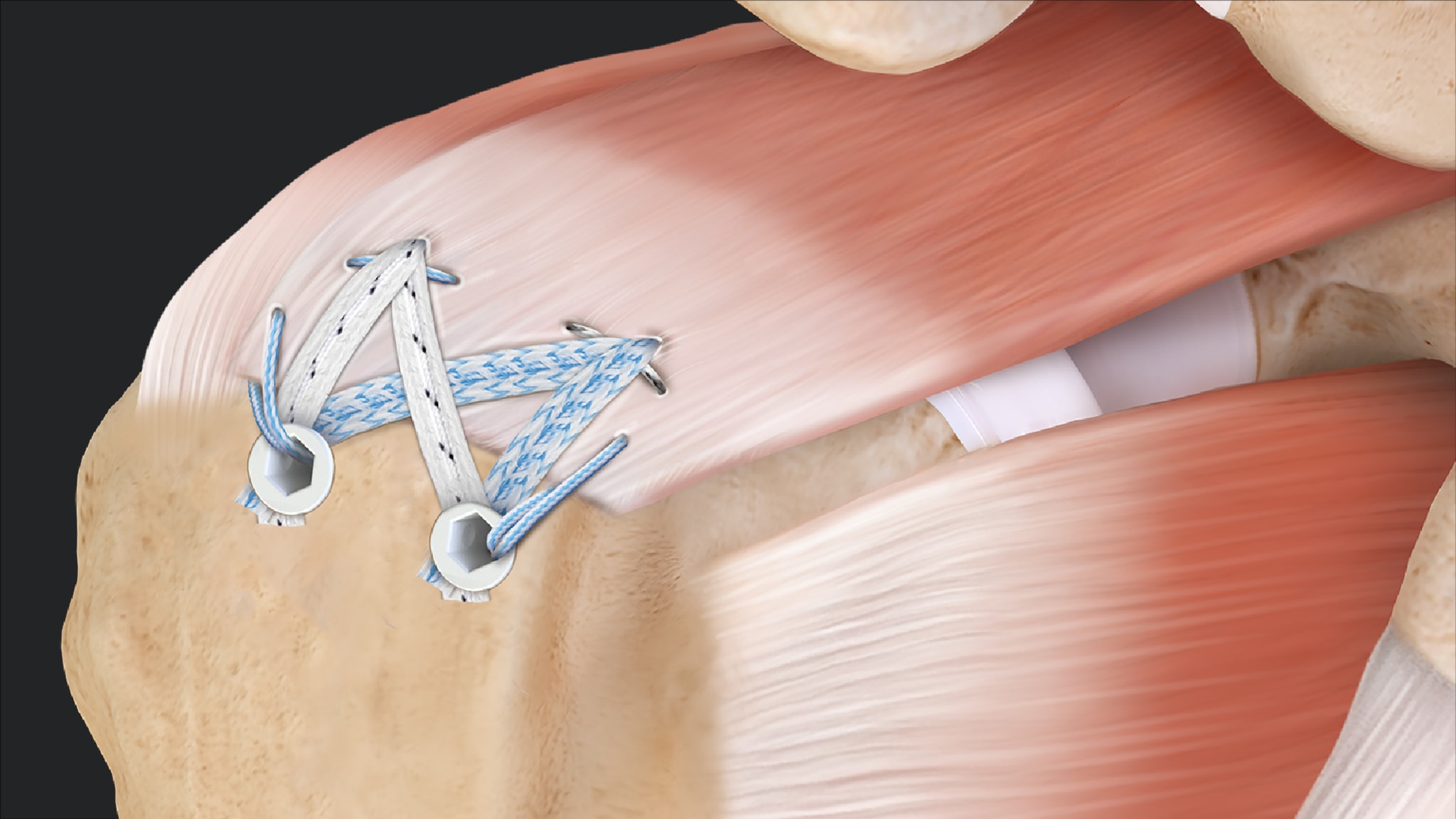SpeedBridge™ Rotator Cuff Repair With Medial Ripstop Sutures and Knotless SwiveLock® Anchor