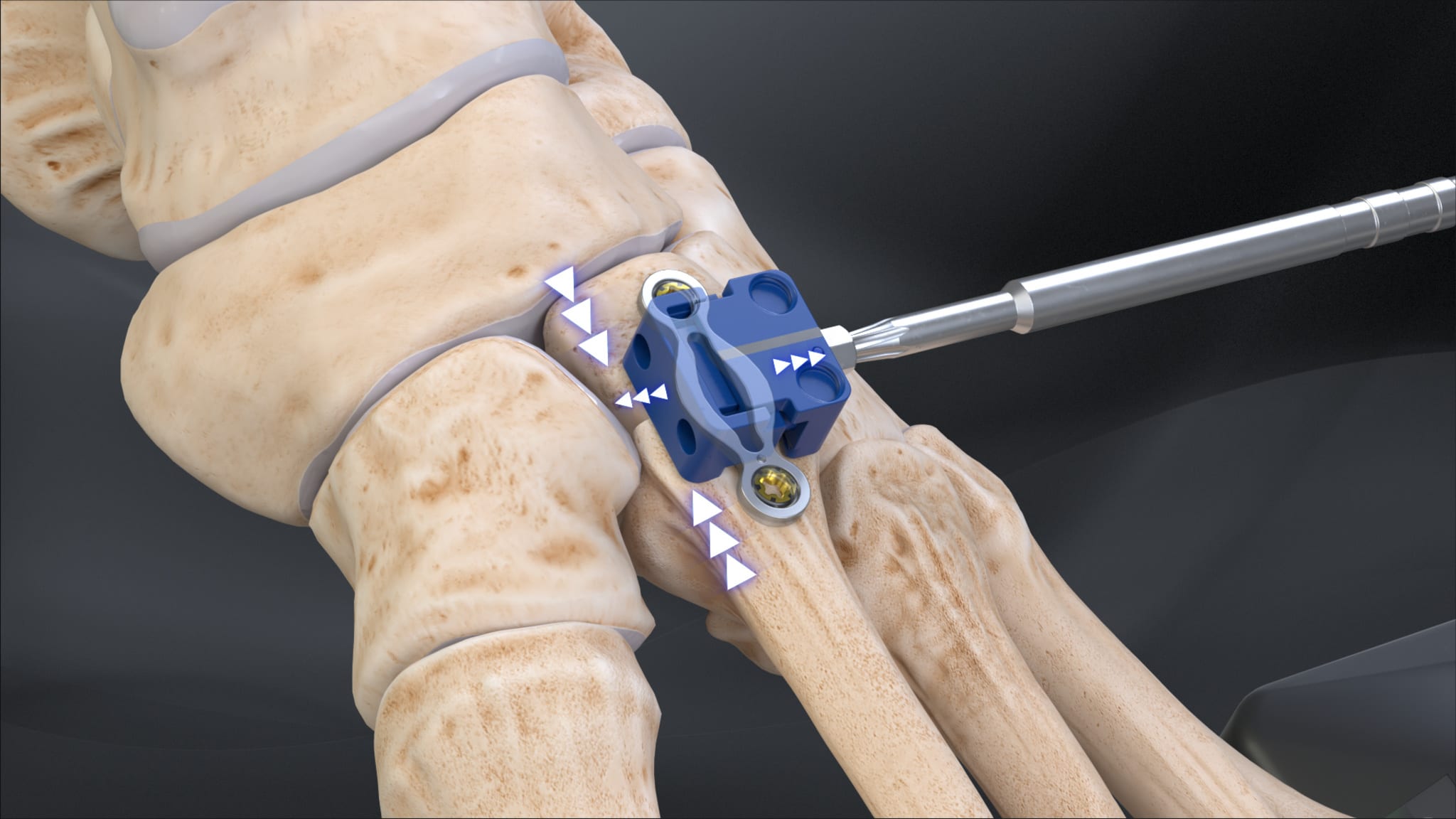 2nd TMT Arthrodesis With DynaNite® Compression Plate and KreuLock™ Screws