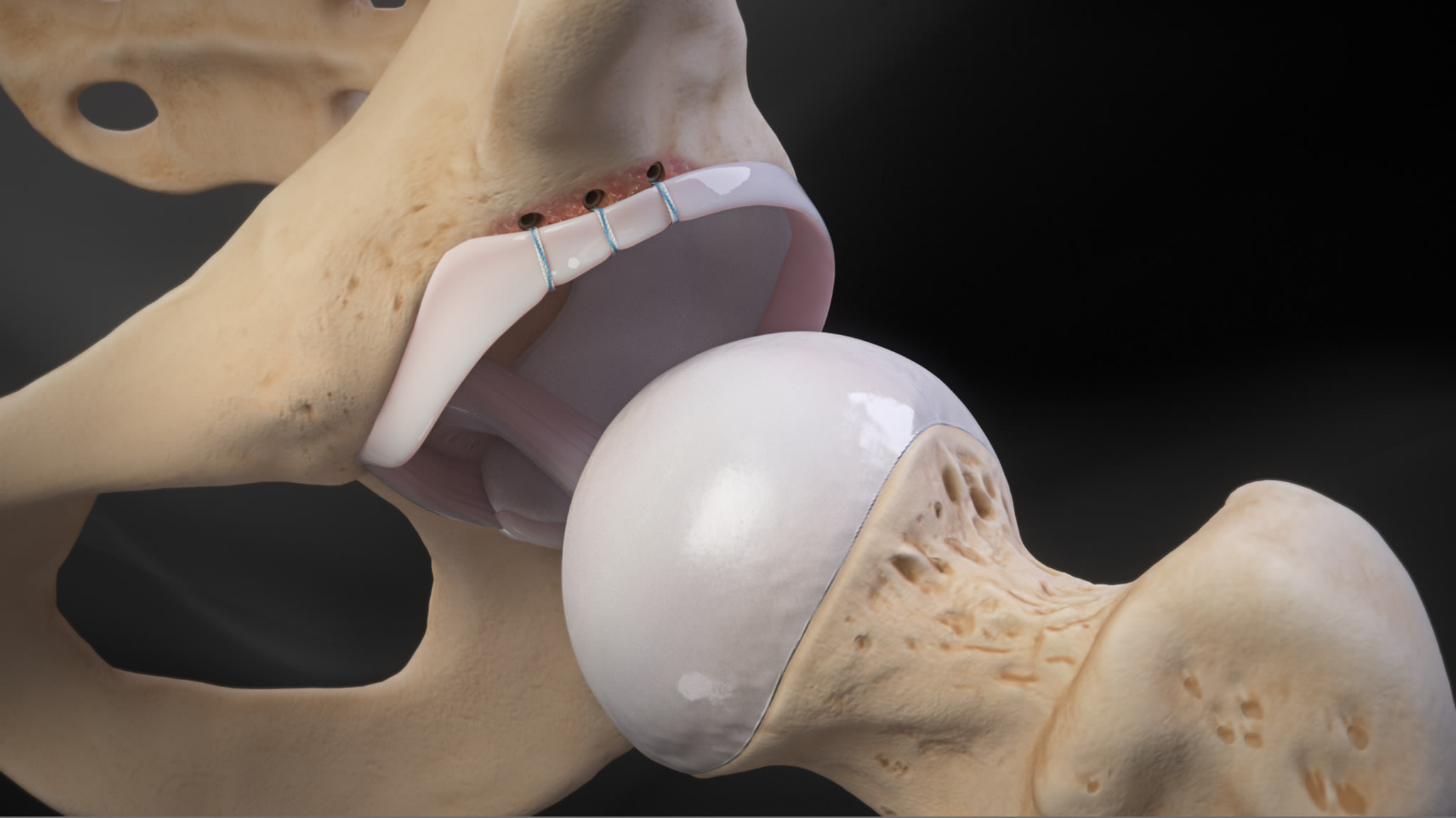 Hip Labral Repair With 2.4 mm Mini Hip PushLock® Anchors