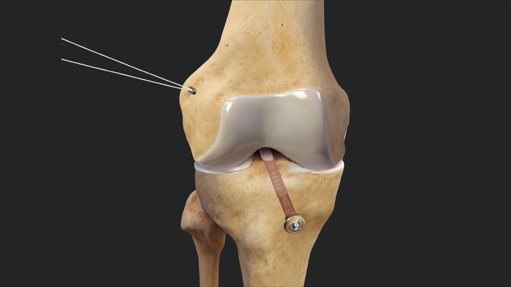 Arthroscopic ACL Reconstruction With ACL Remnant Preservation